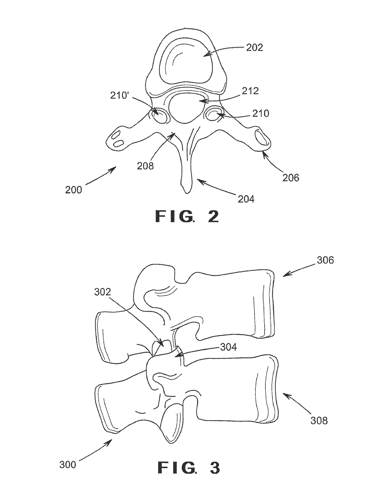 Device and Method for Treatment of Spondylotic Disease