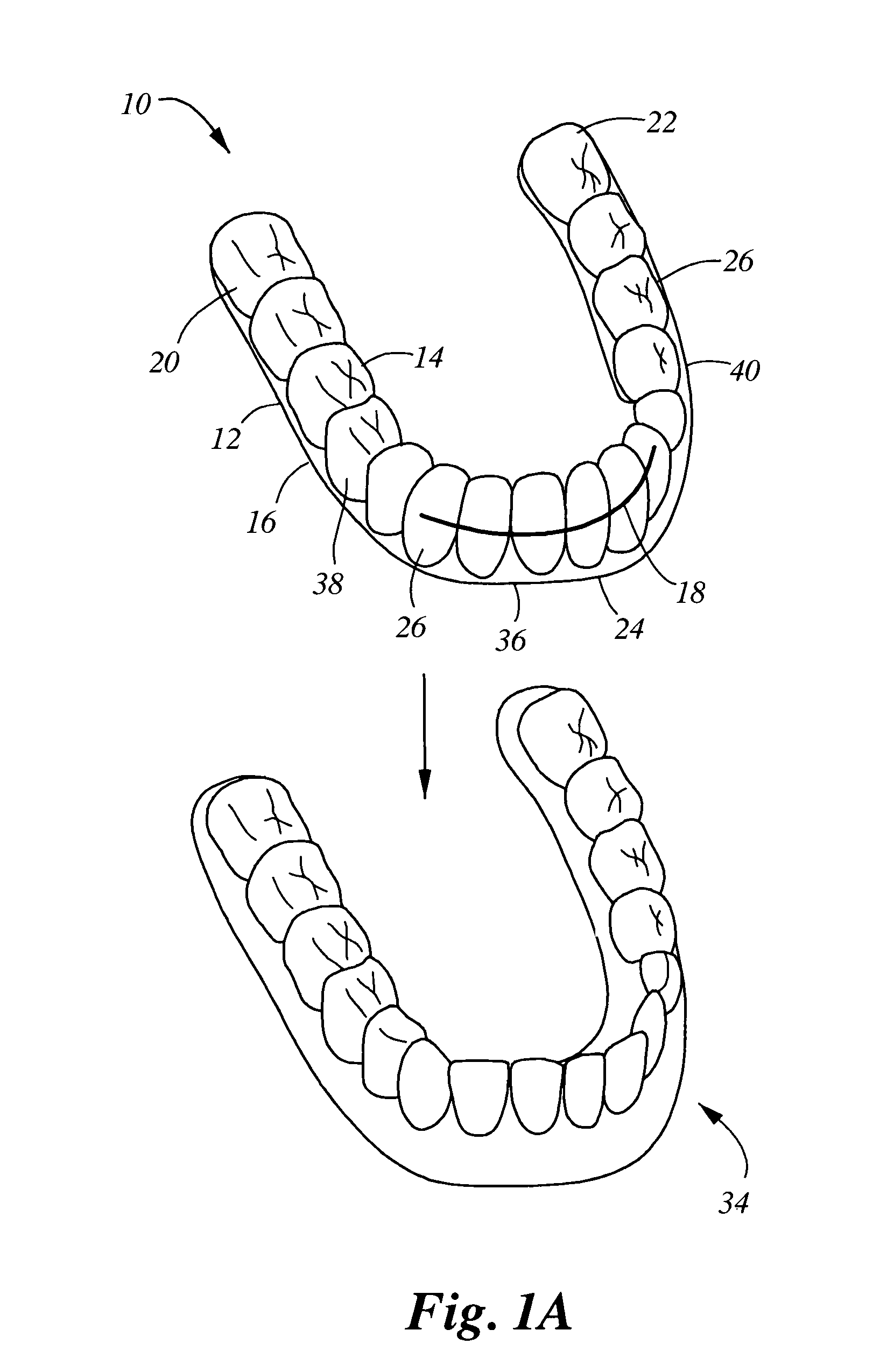 Orthodontic appliance with embedded wire for moving teeth