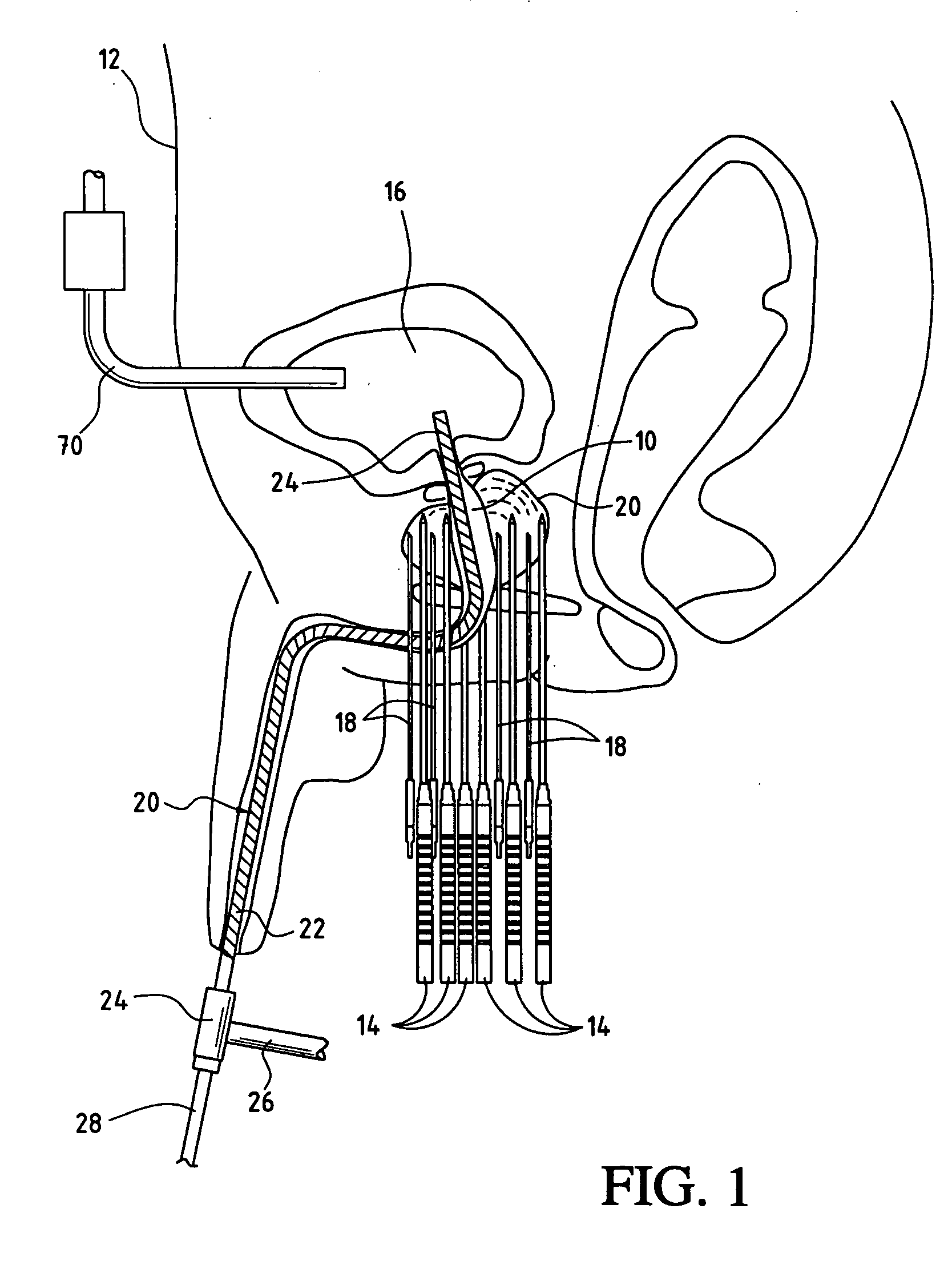 Closed system warming catheter and method of use