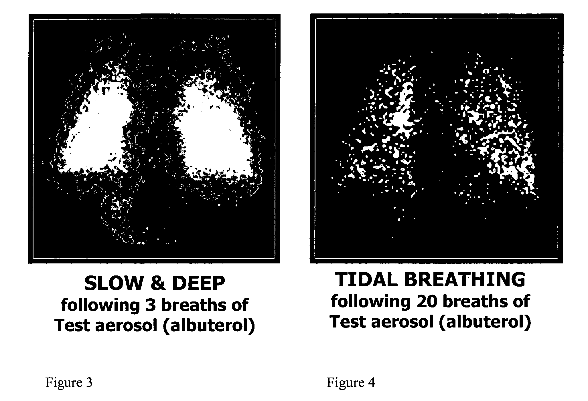 Method of treating tuberculosis with interferons