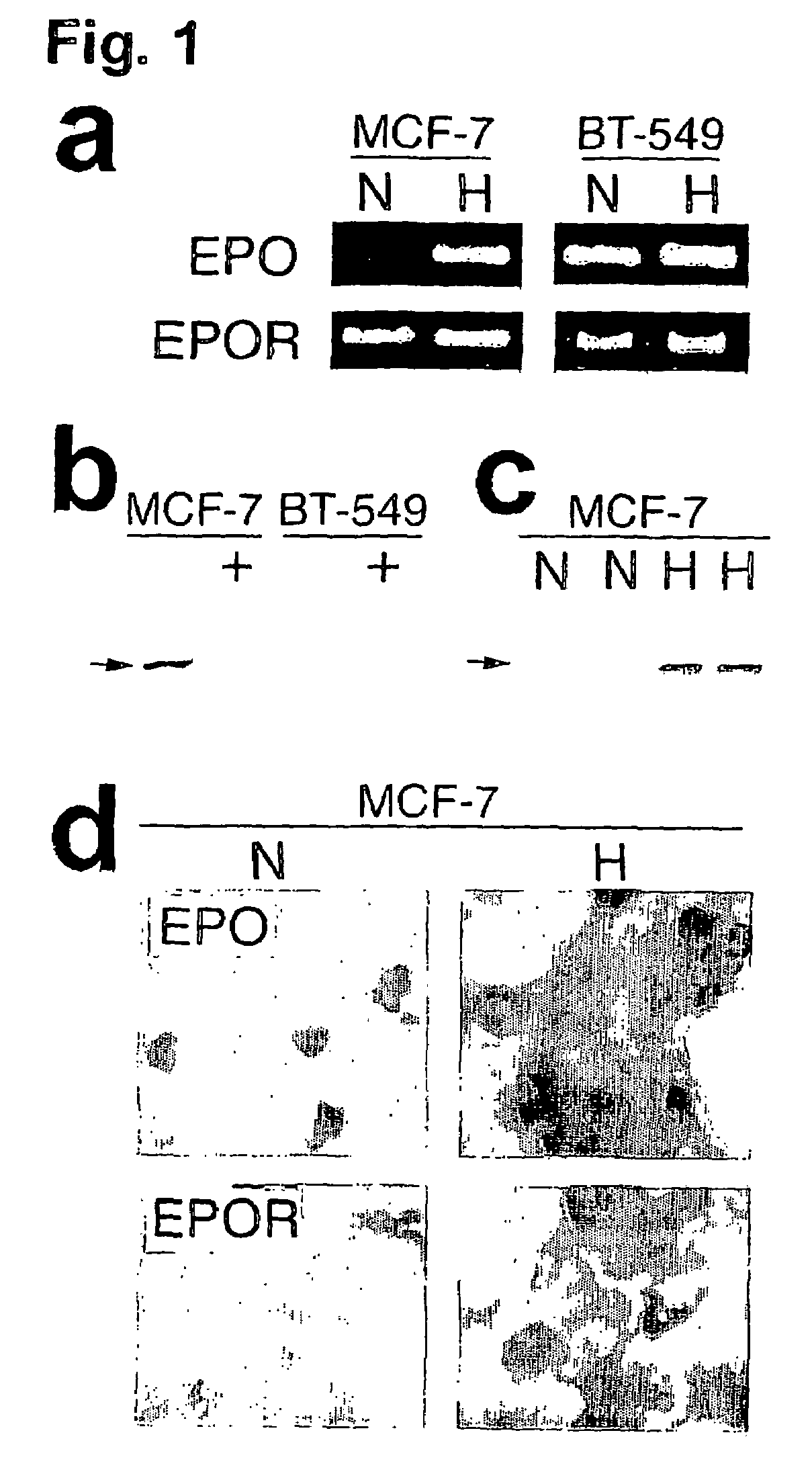 Erythropoietin and erythropoietin receptor expression in human cancer