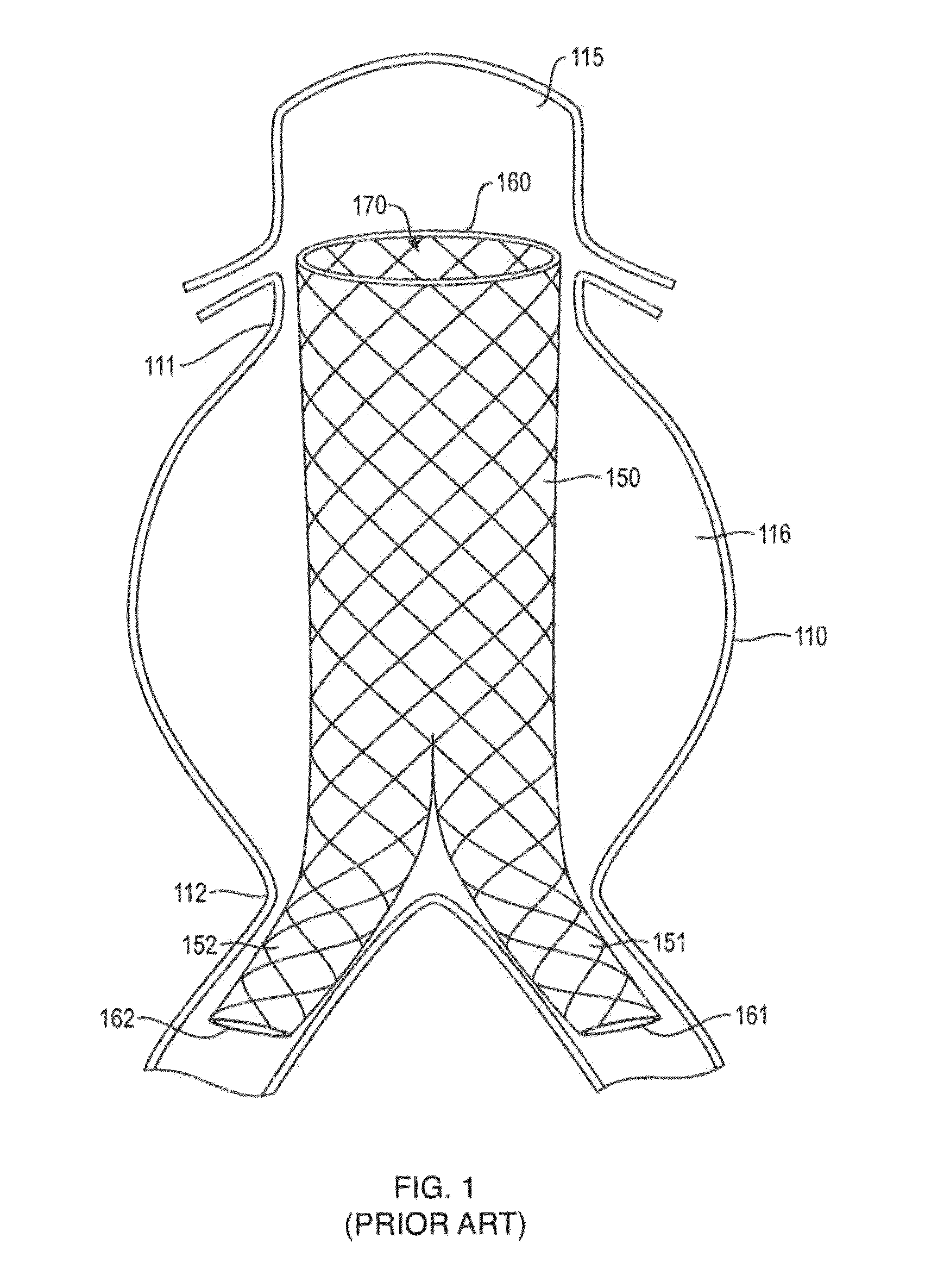 In-situ forming foams with outer layer