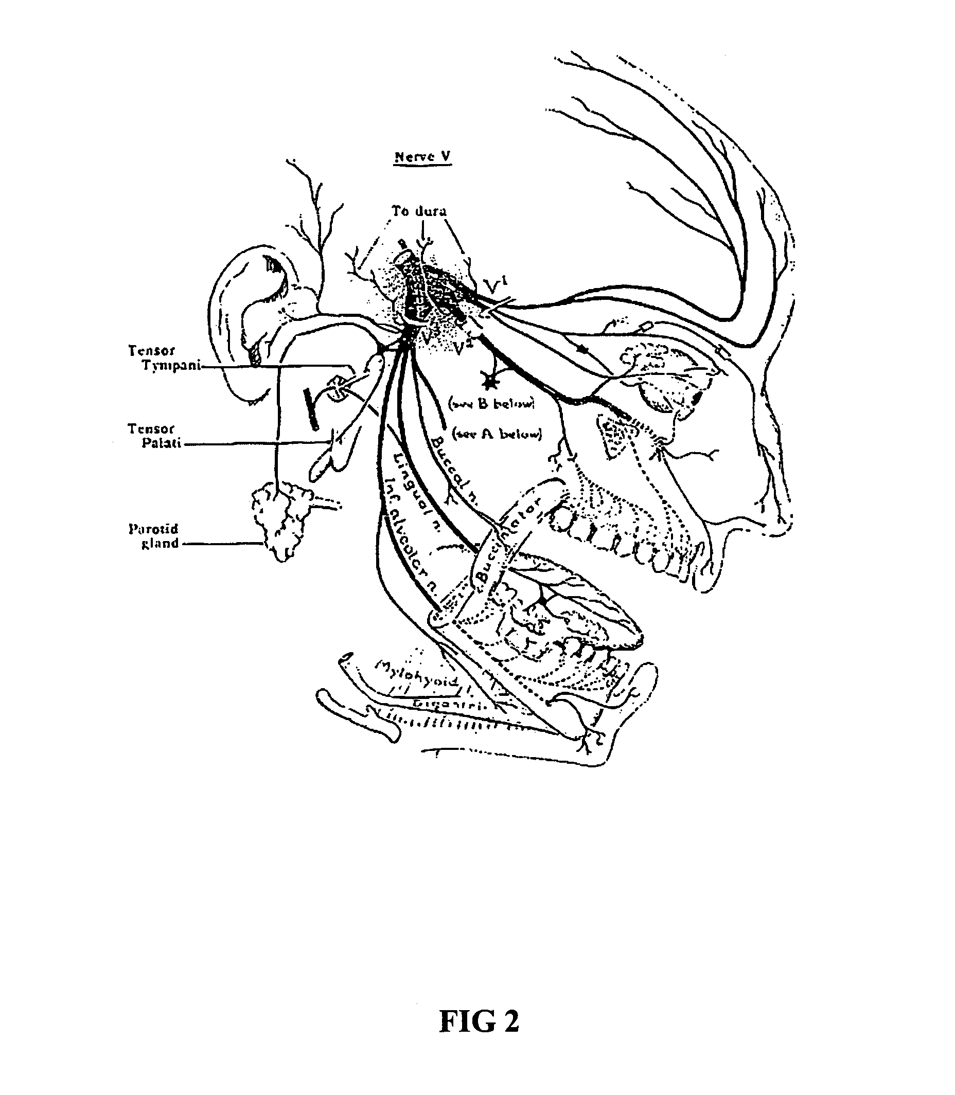 Treatment of sinusitis related chronic facial pain and headache with botulinum toxin injections