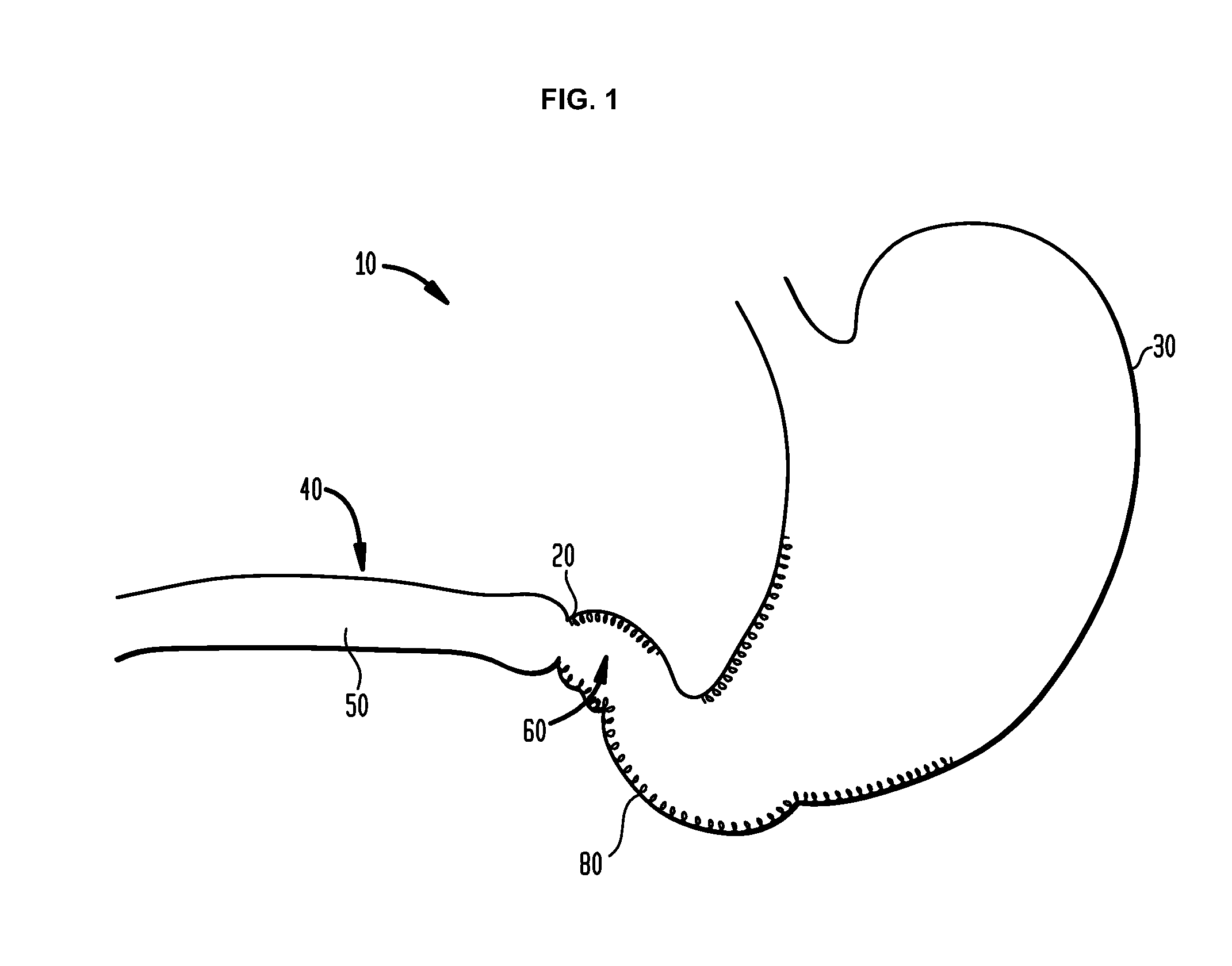 Systems and methods for treatment of obesity and type 2 diabetes