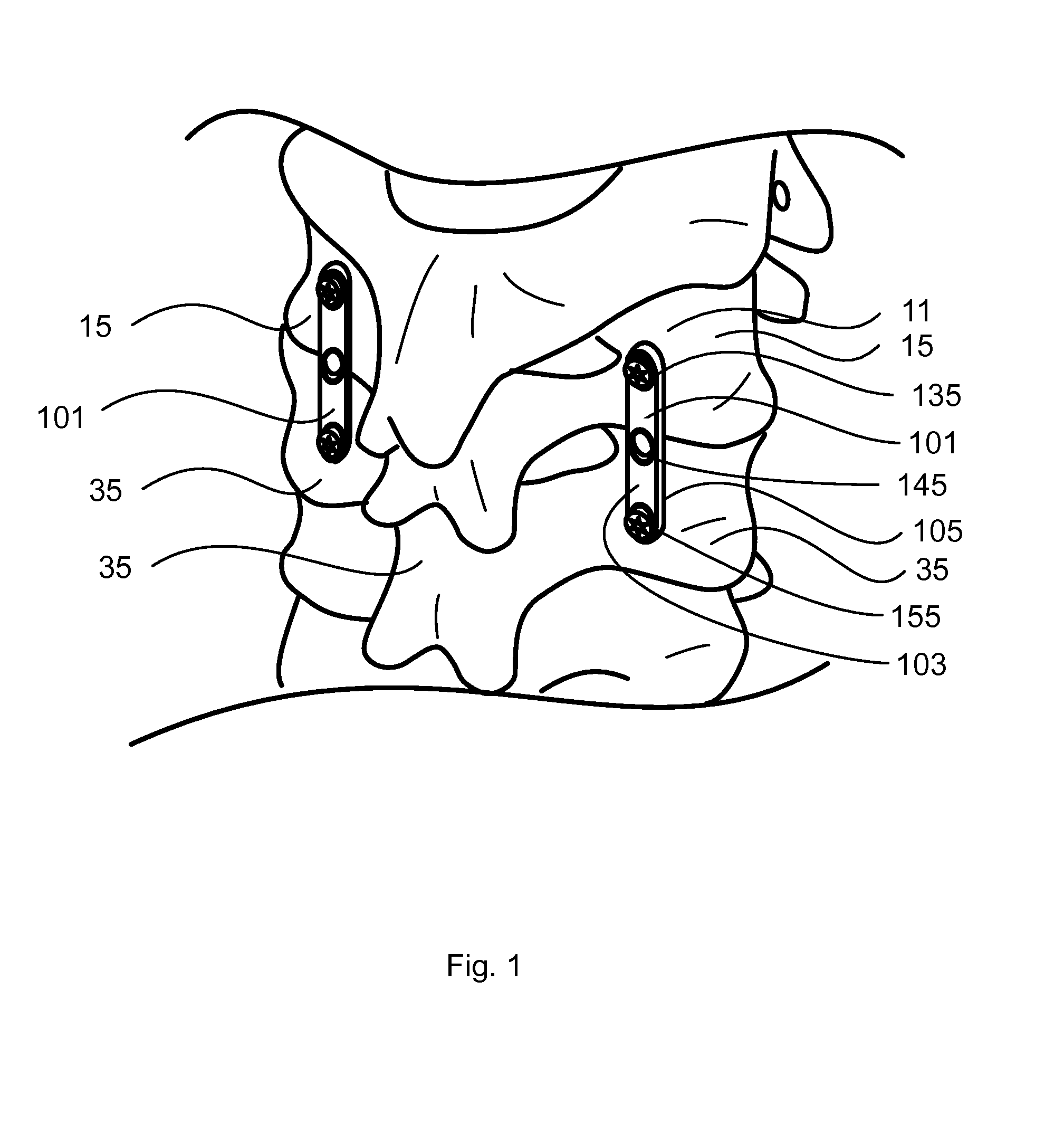 Spine Fixation Device and Method