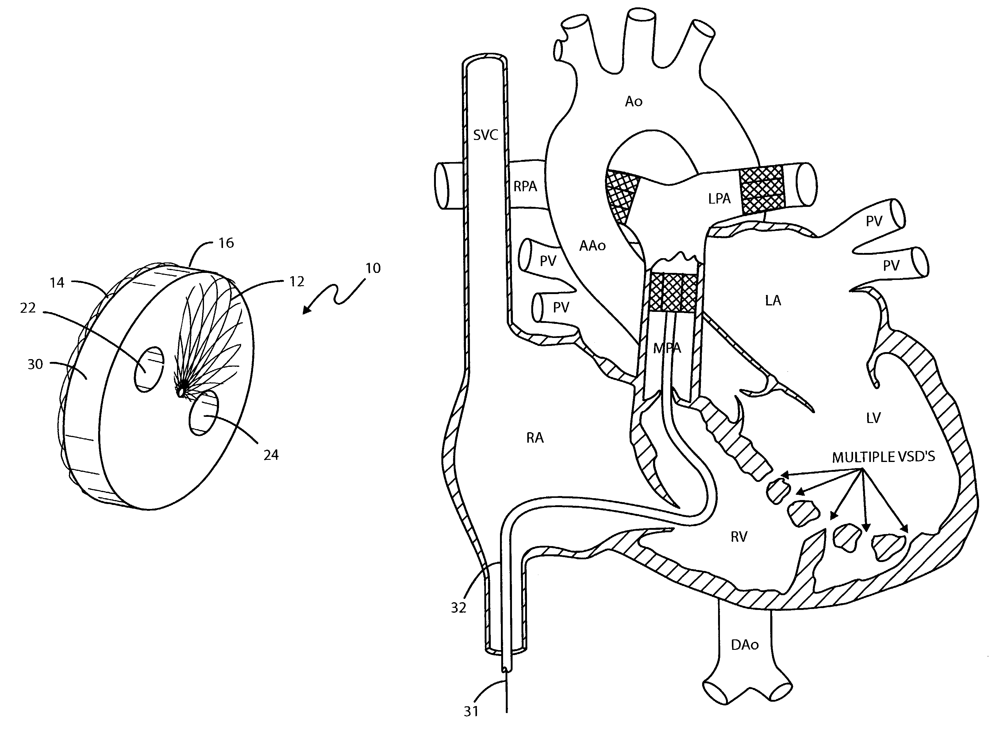 Intravascular flow restrictor