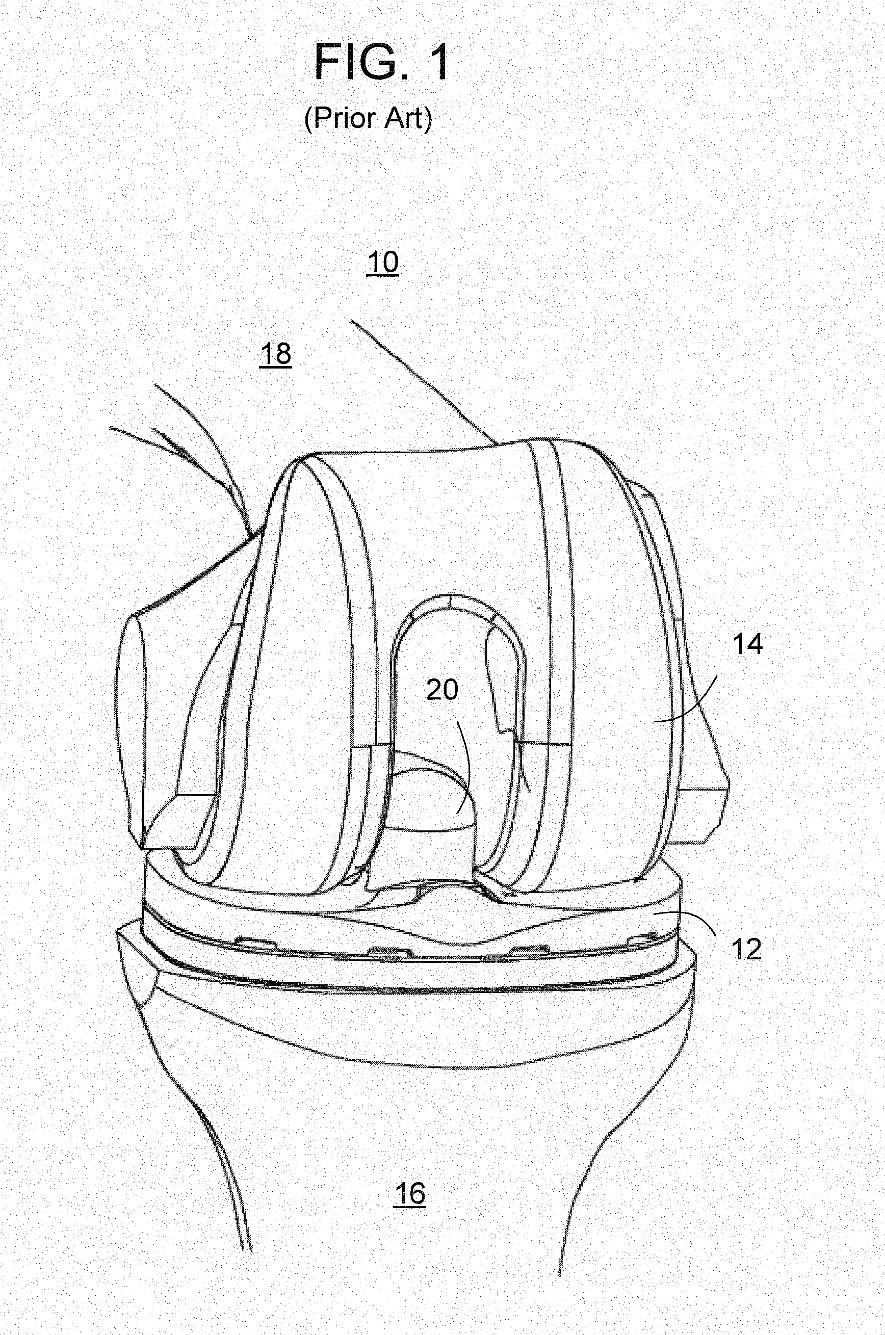 Methods And Apparatus For Preparing An Intercondylar Area Of A Distal Femur