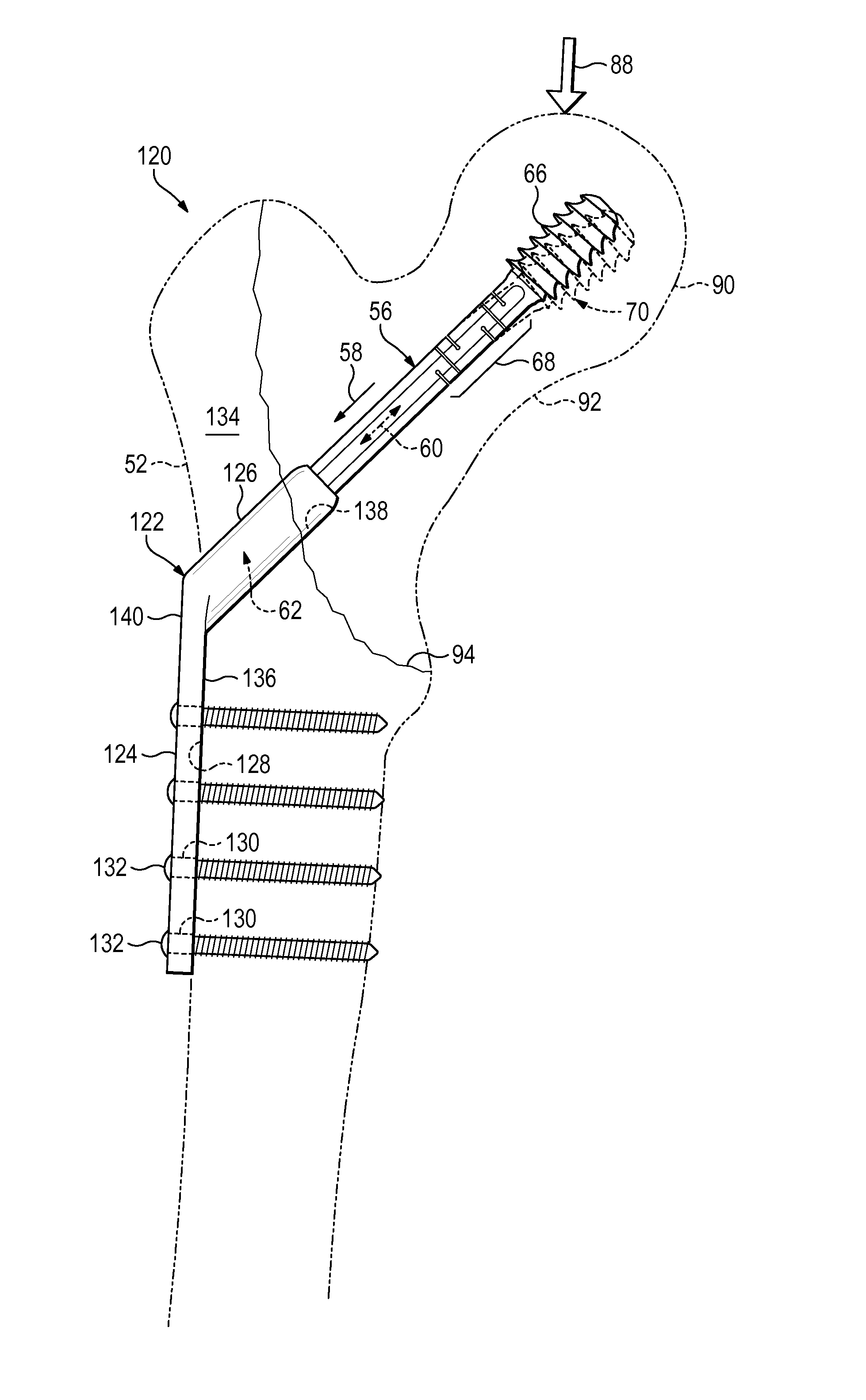 Hip fixation system with a compliant fixation element