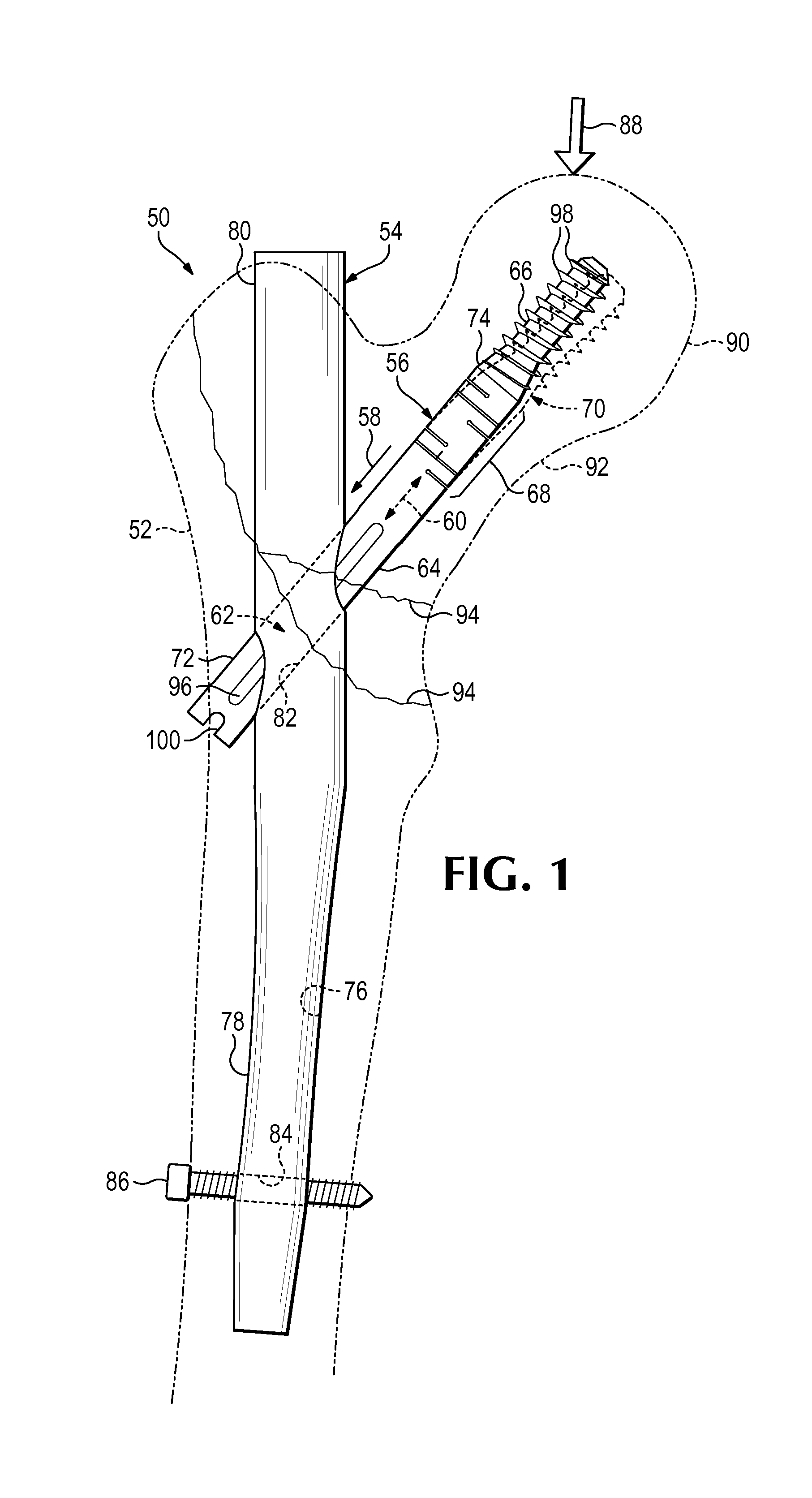 Hip fixation system with a compliant fixation element