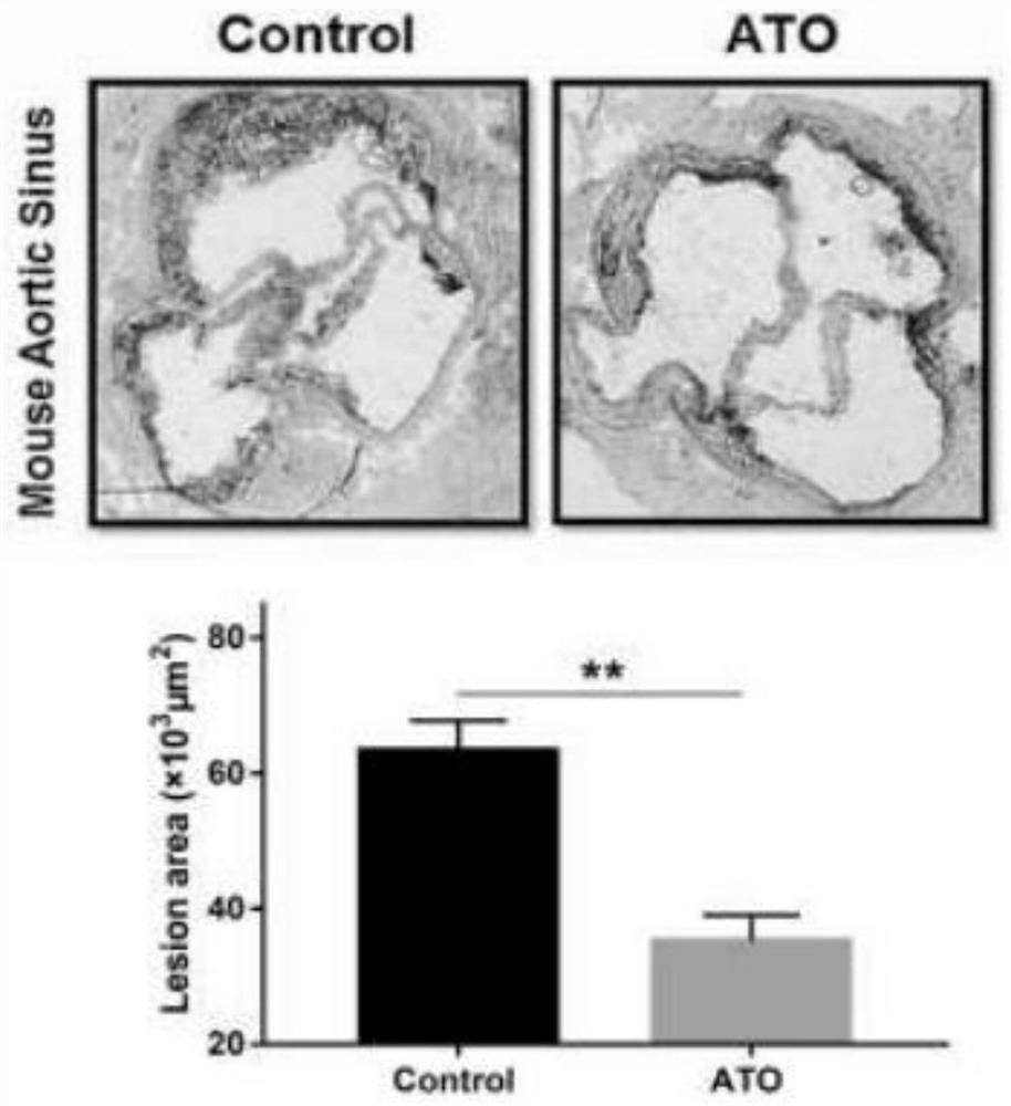 Use of arsenic trioxide in the preparation of drugs for treating advanced atherosclerosis