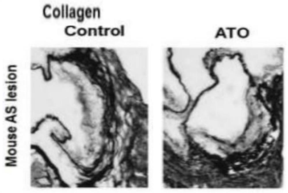 Use of arsenic trioxide in the preparation of drugs for treating advanced atherosclerosis