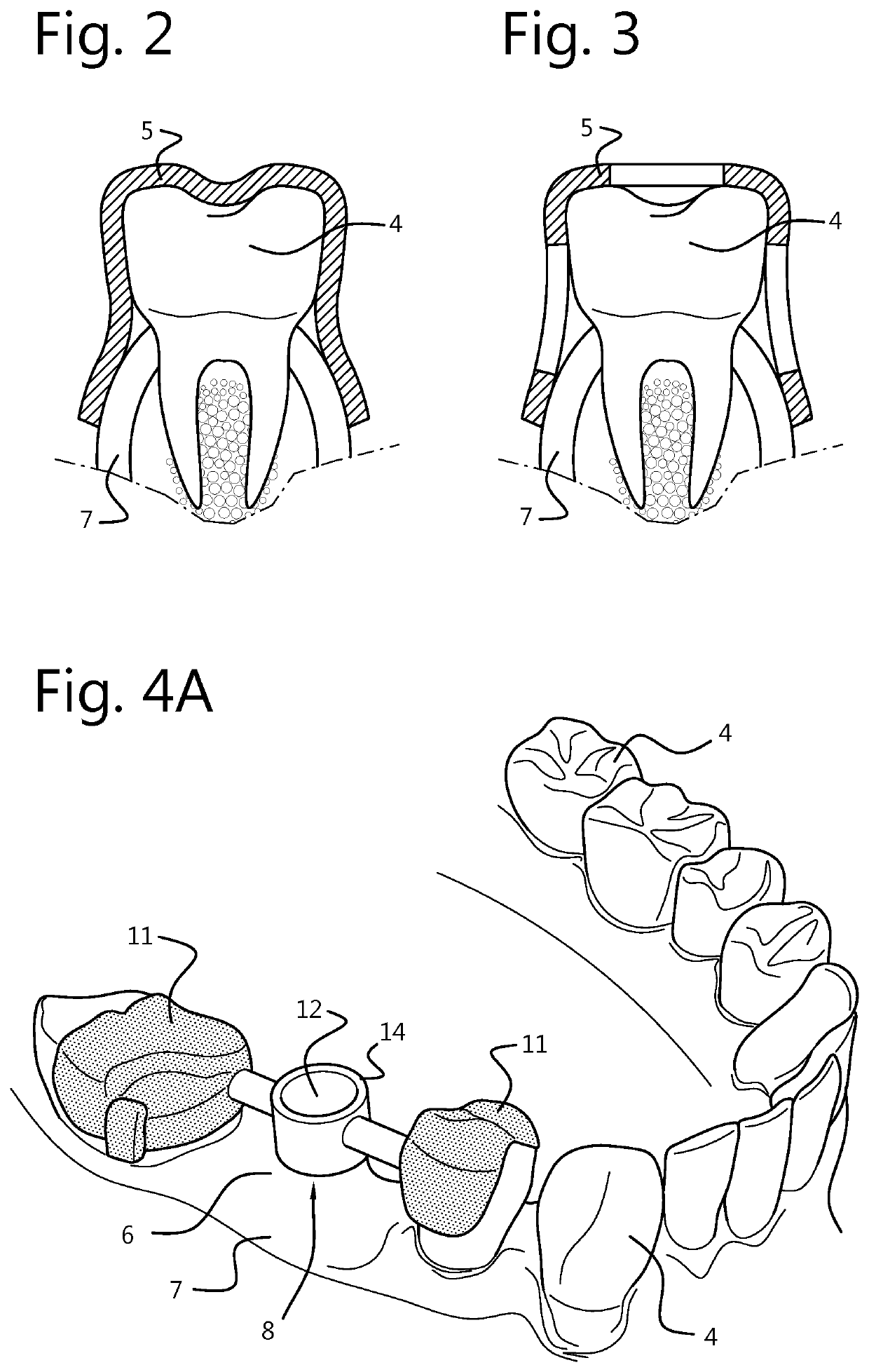 Force-closure or form-closure positioning of surgical templates for guided implant dentistry