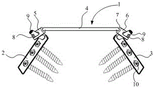 Iliac fixation device