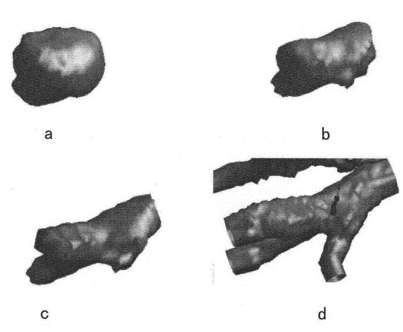 Three-dimensional lung vessel image segmentation method based on geometric deformation model