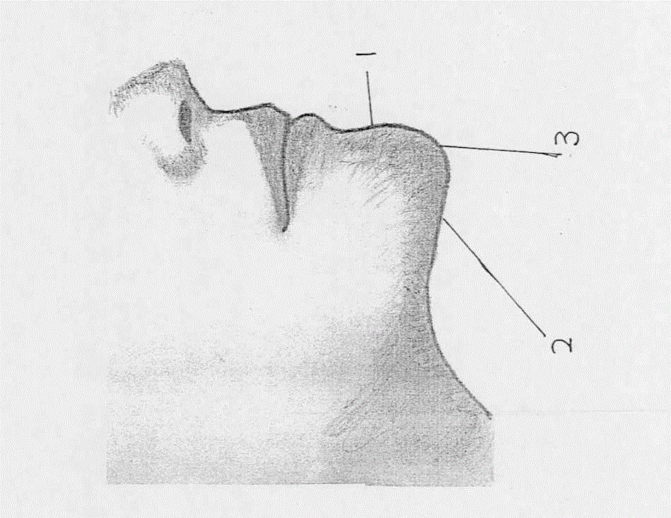 Anti-snoring method by surrounding jaw