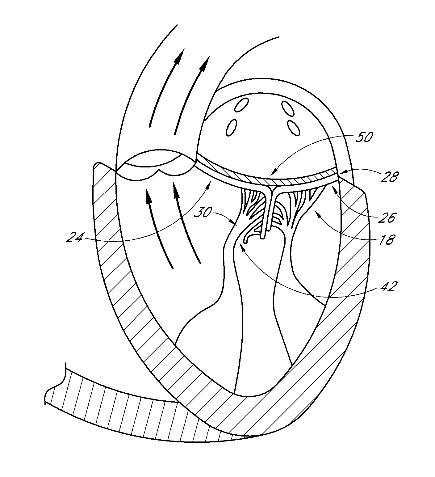 Transvalvular intraanular band and chordae cutting for ischemic and dilated cardiomyopathy