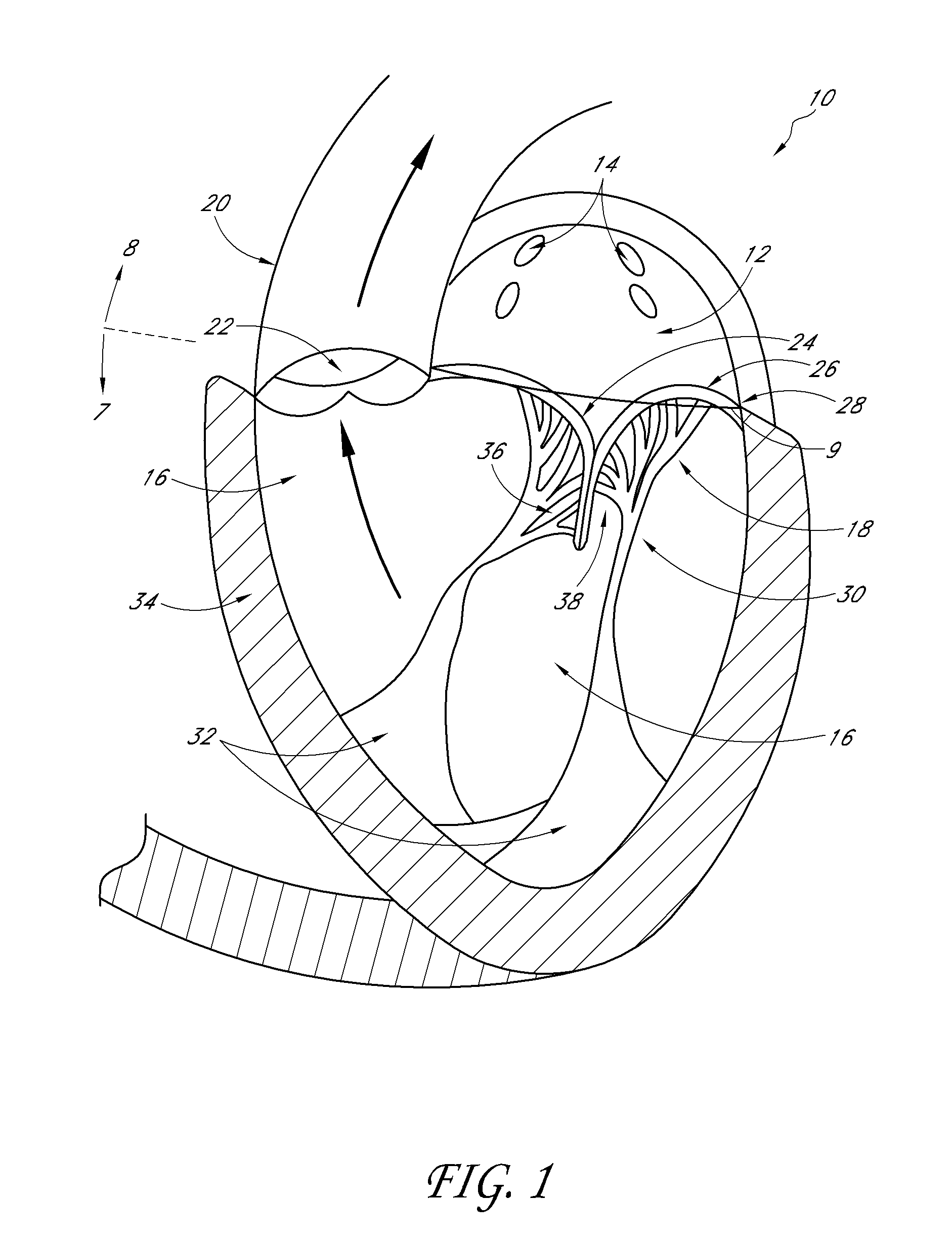 Transvalvular intraanular band and chordae cutting for ischemic and dilated cardiomyopathy