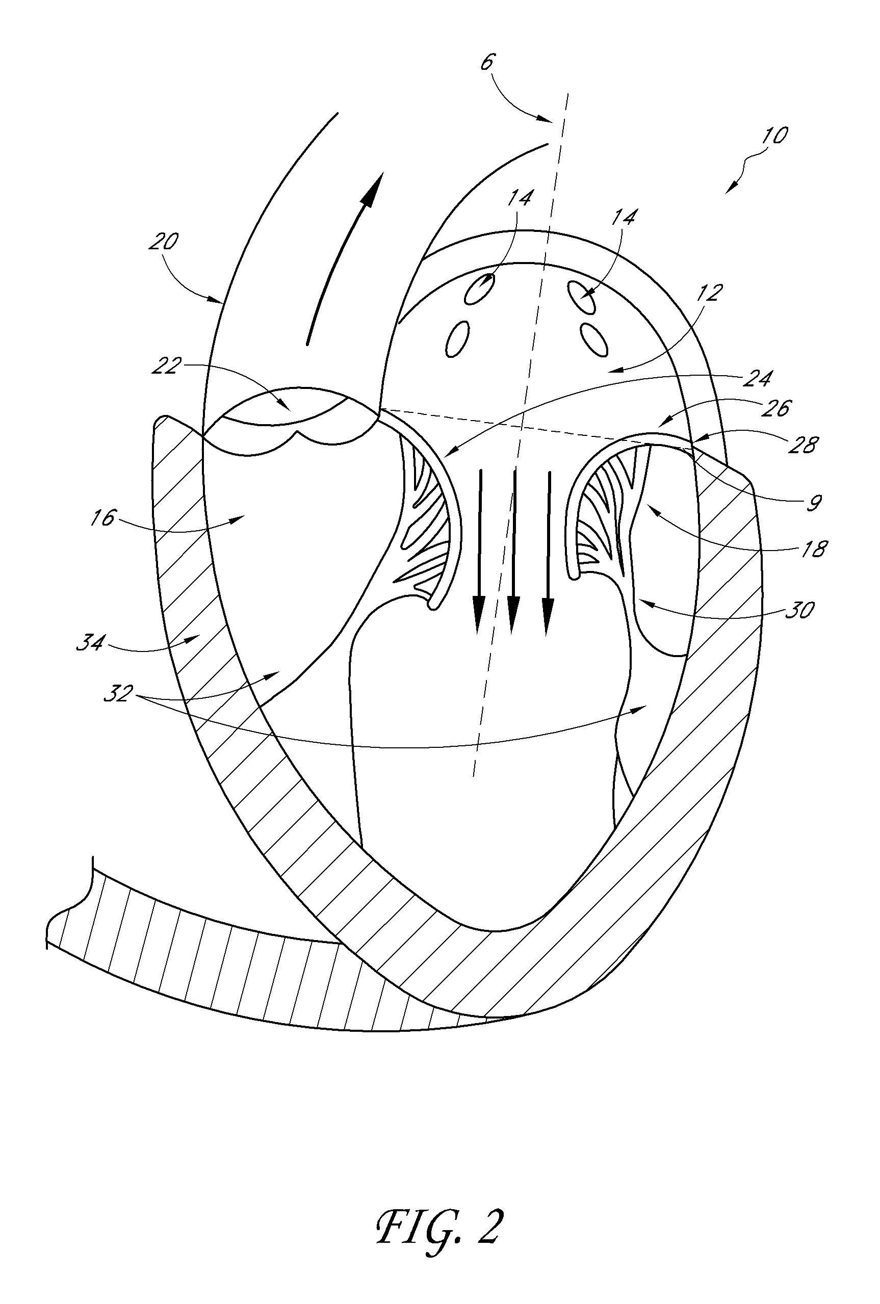 Transvalvular intraanular band and chordae cutting for ischemic and dilated cardiomyopathy