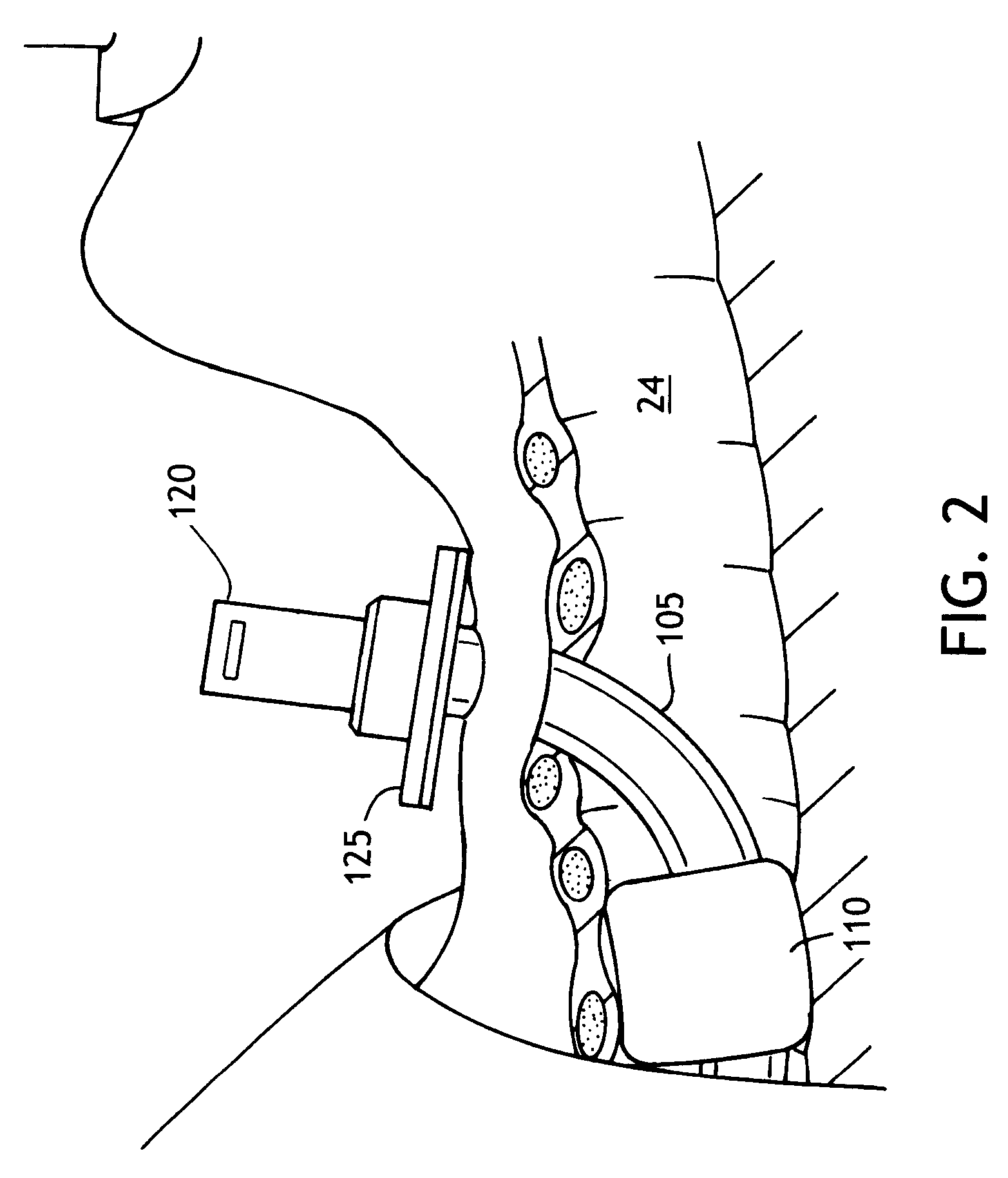 Method of making an improved balloon cuff tracheostomy tube