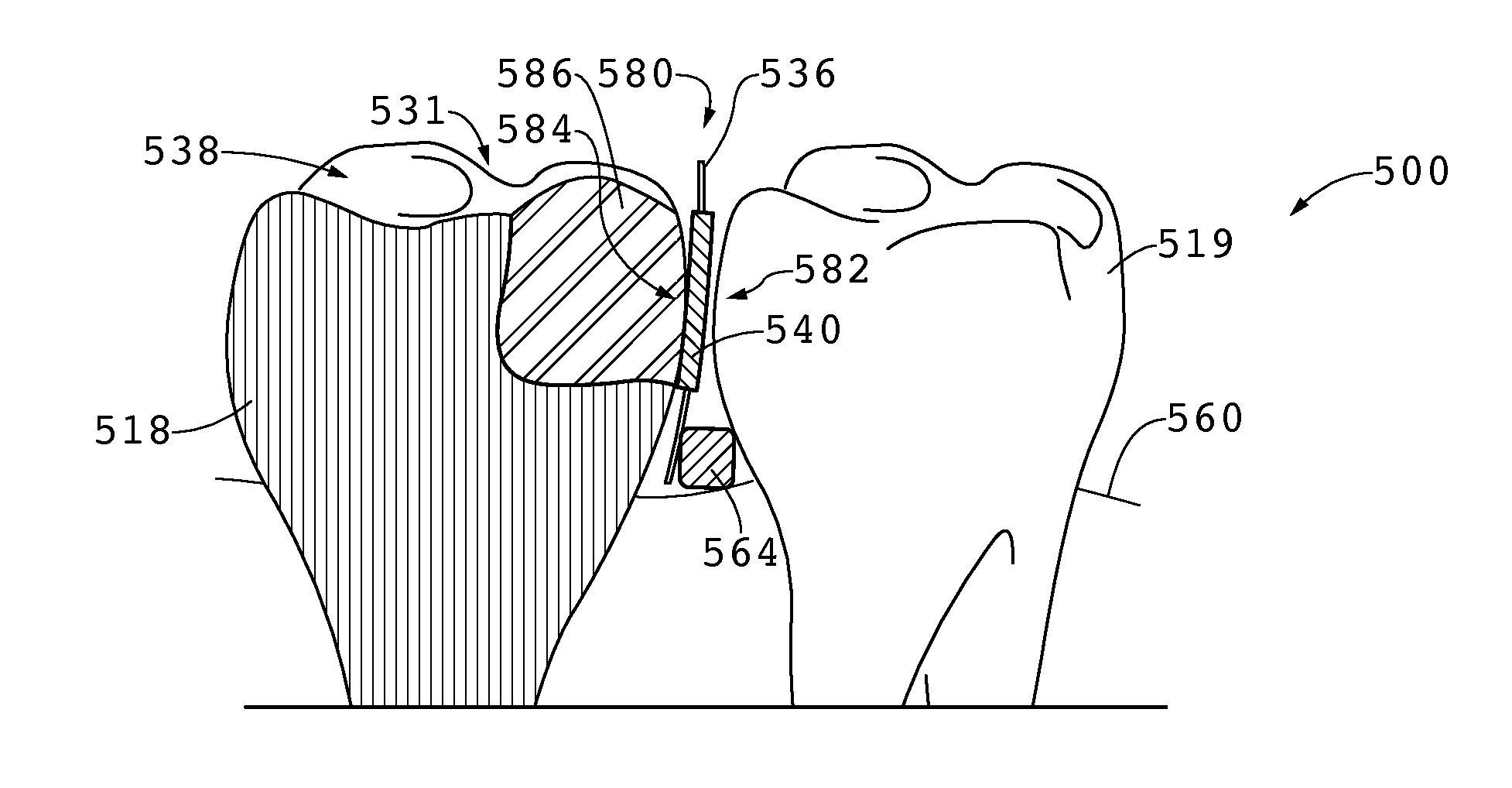 System for Maintaining Tooth Contact During Interproximal Dental Restoration