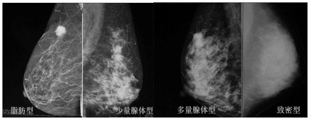 A method and system for automatic detection of breast lumps