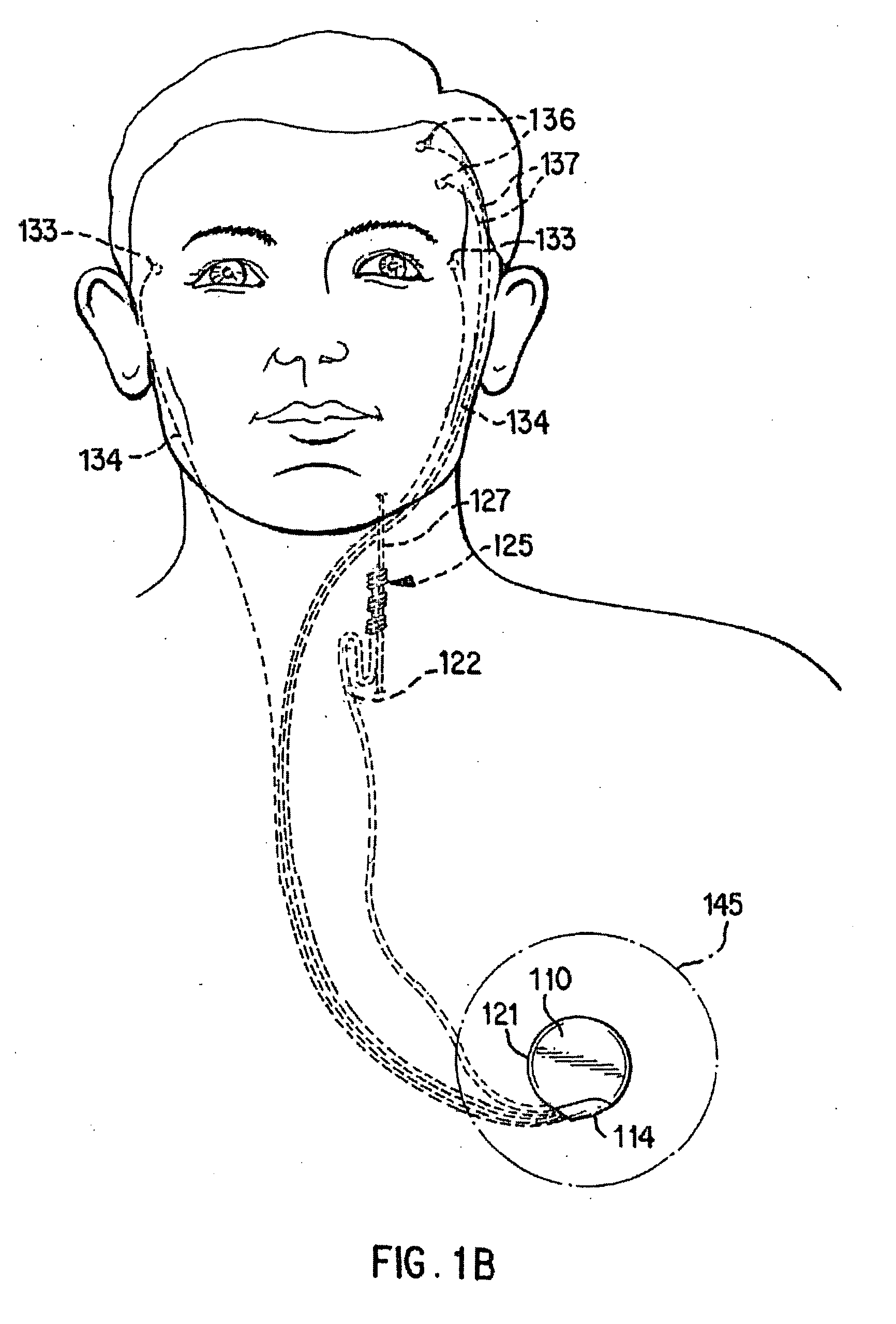 Safe-mode operation of an implantable medical device