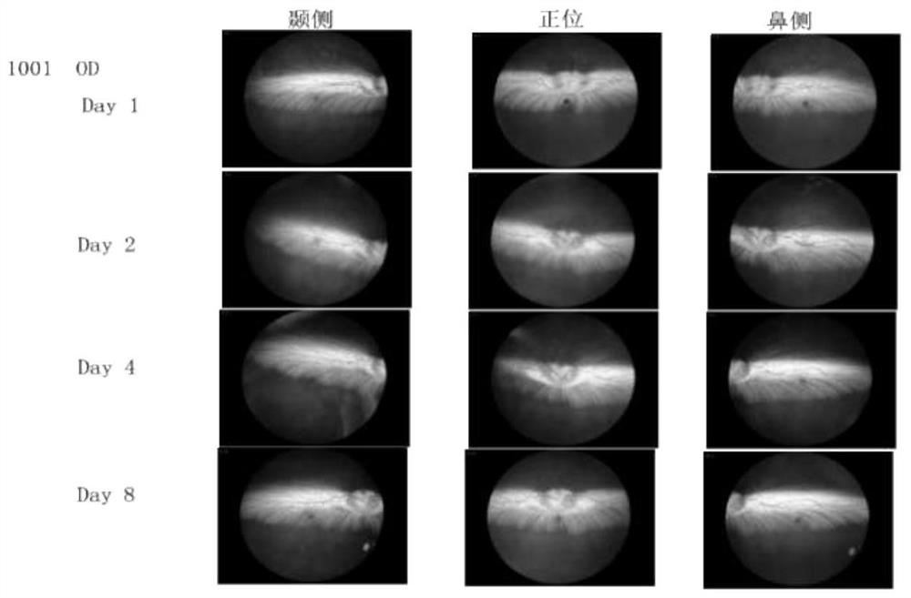 Application of antiplatelet thrombolysin to preparation of medicine for treating retinal vein occlusion diseases