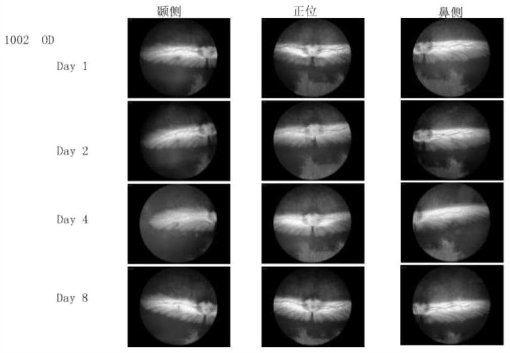 Application of antiplatelet thrombolysin to preparation of medicine for treating retinal vein occlusion diseases