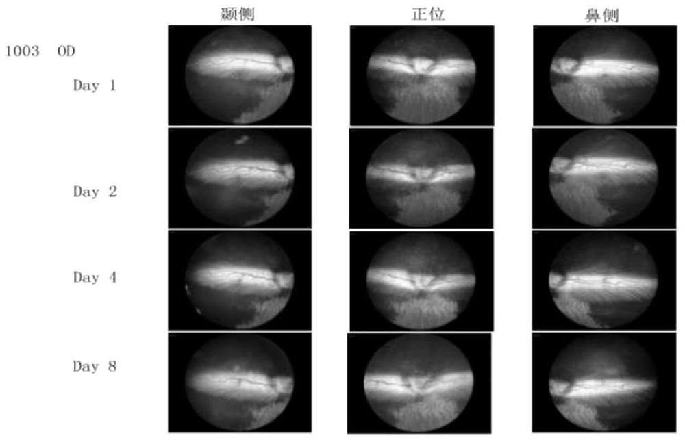 Application of antiplatelet thrombolysin to preparation of medicine for treating retinal vein occlusion diseases