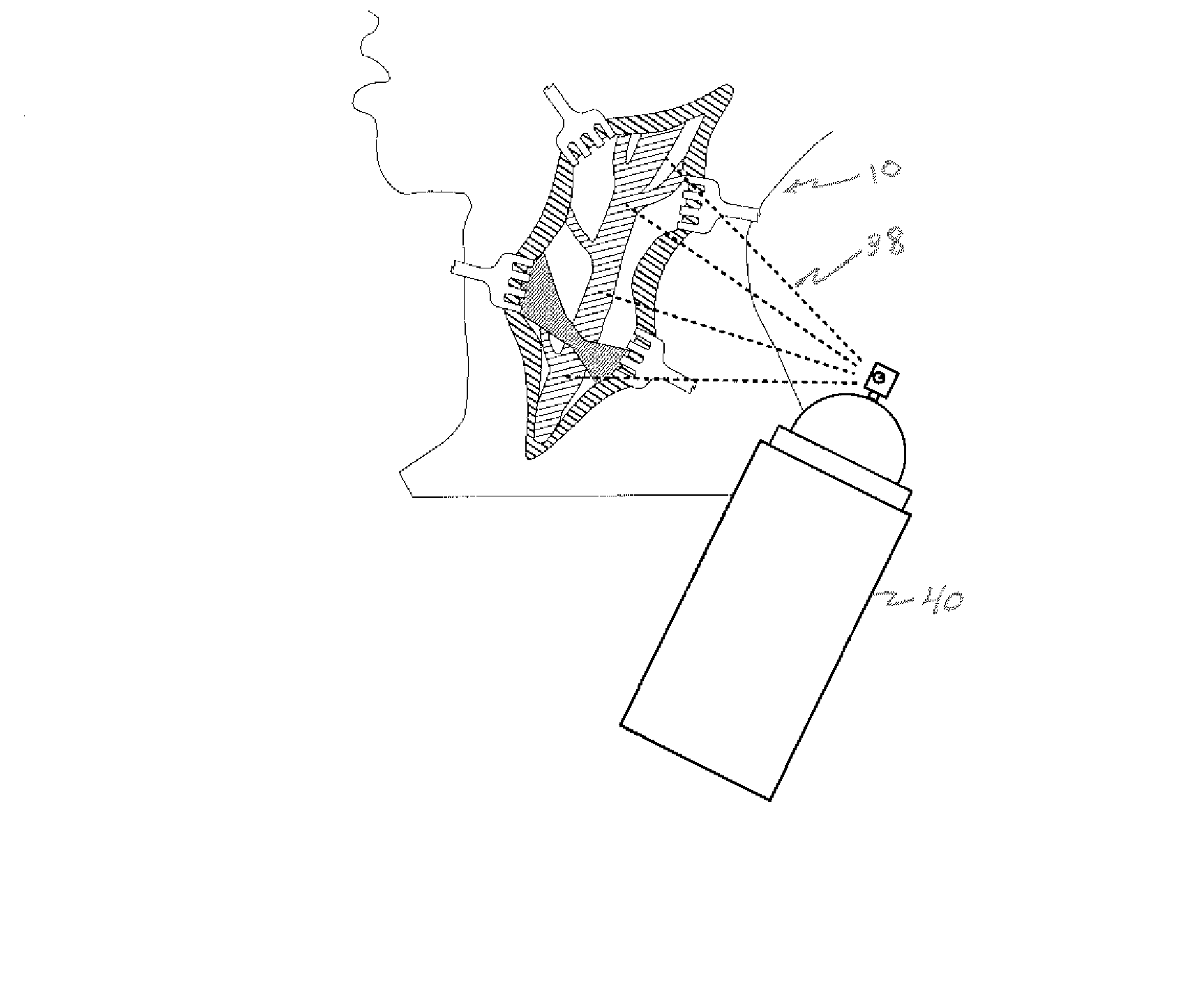 Method of inhibiting the formation of adhesions and scar tissue and reducing blood loss