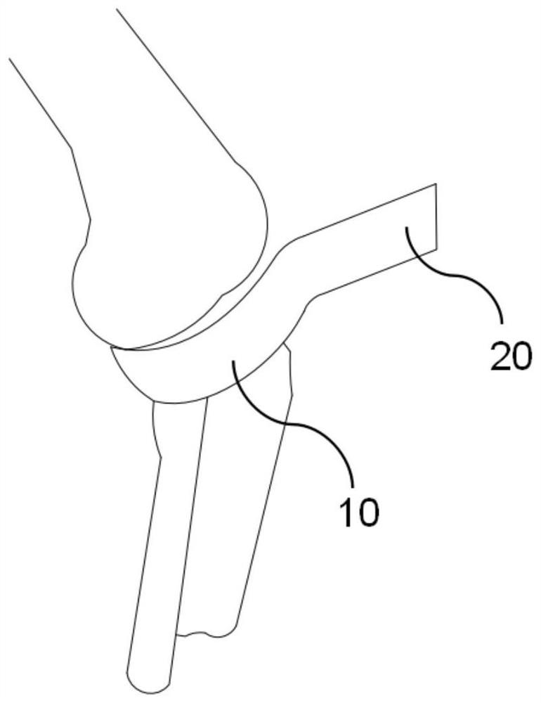 Osteotomy protector for unicompartmental knee arthroplasty