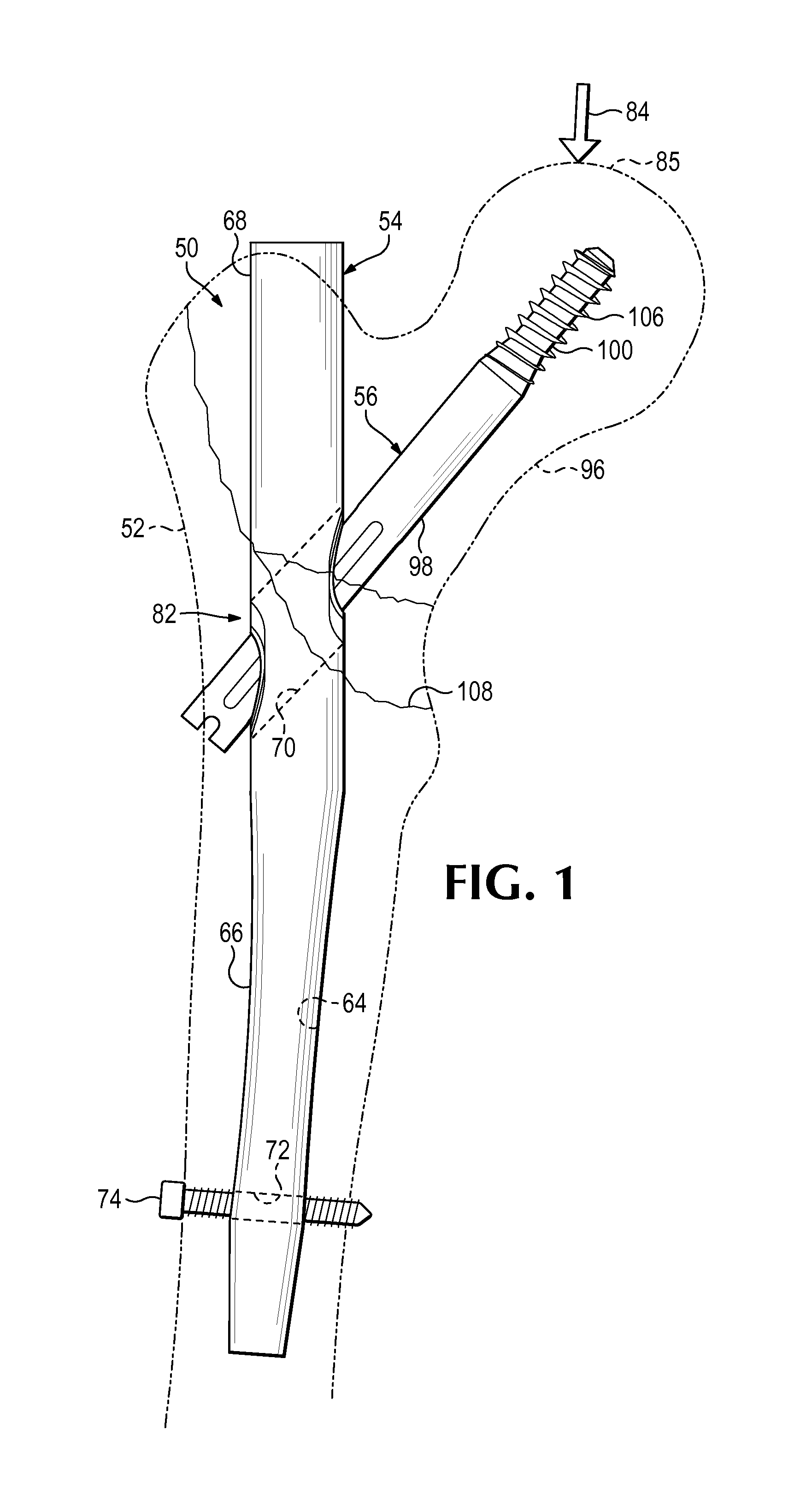 Nail-based compliant hip fixation system