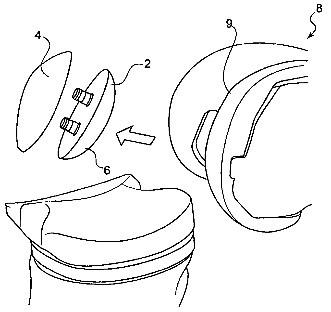 Patellar Components