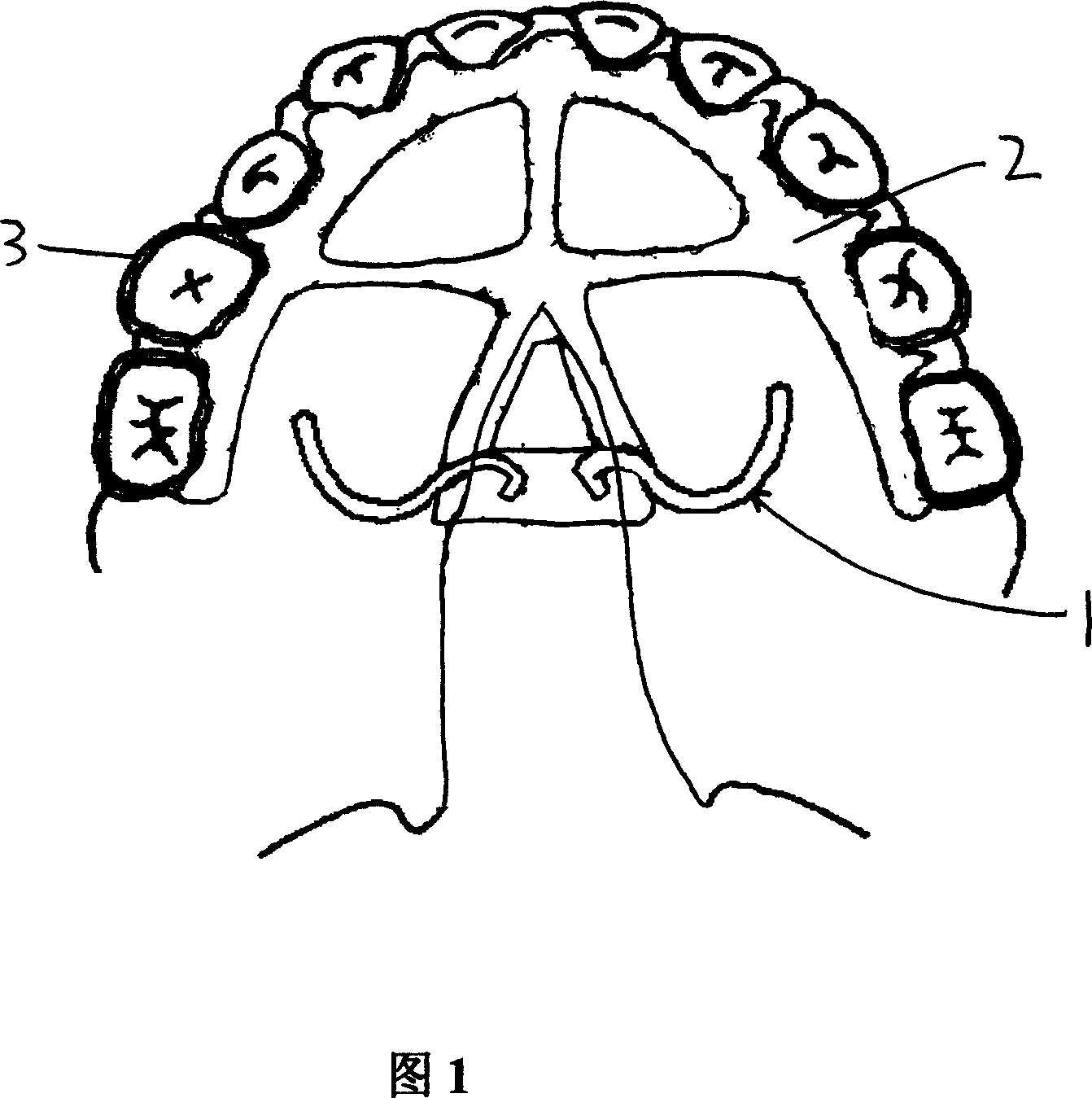 Traction device used in oral cavity for treating cleft palate made of nickel-titanium memory alloy