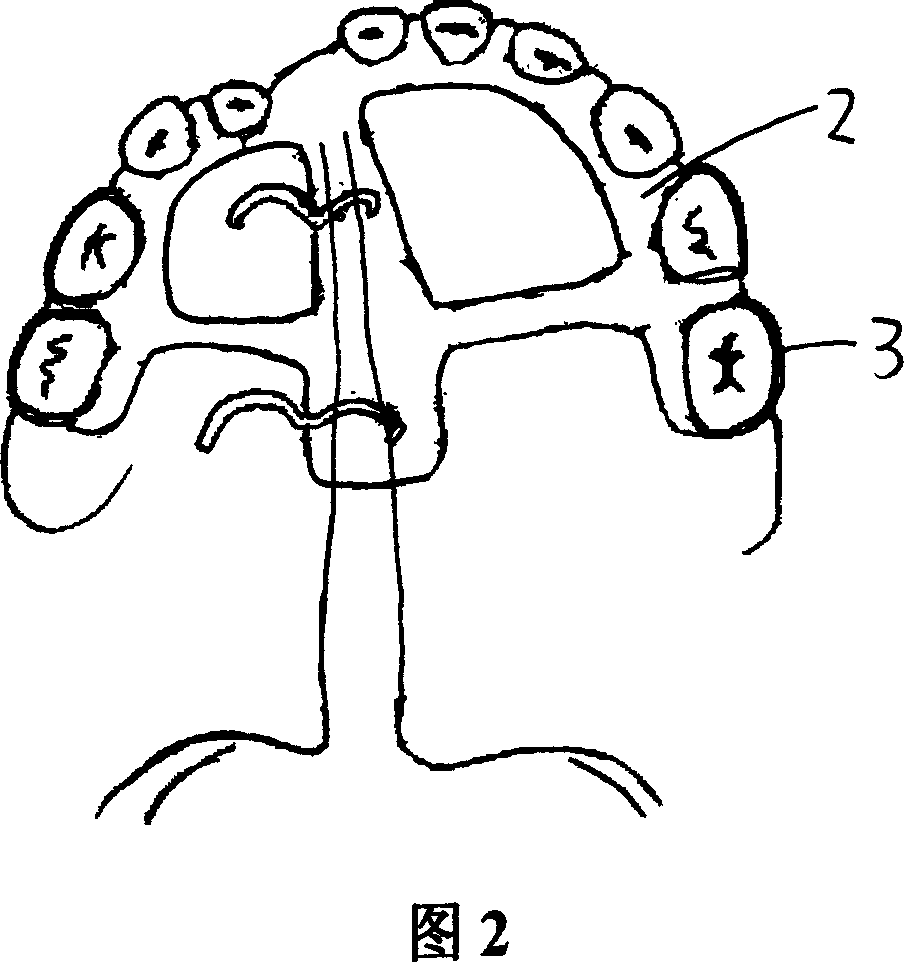 Traction device used in oral cavity for treating cleft palate made of nickel-titanium memory alloy