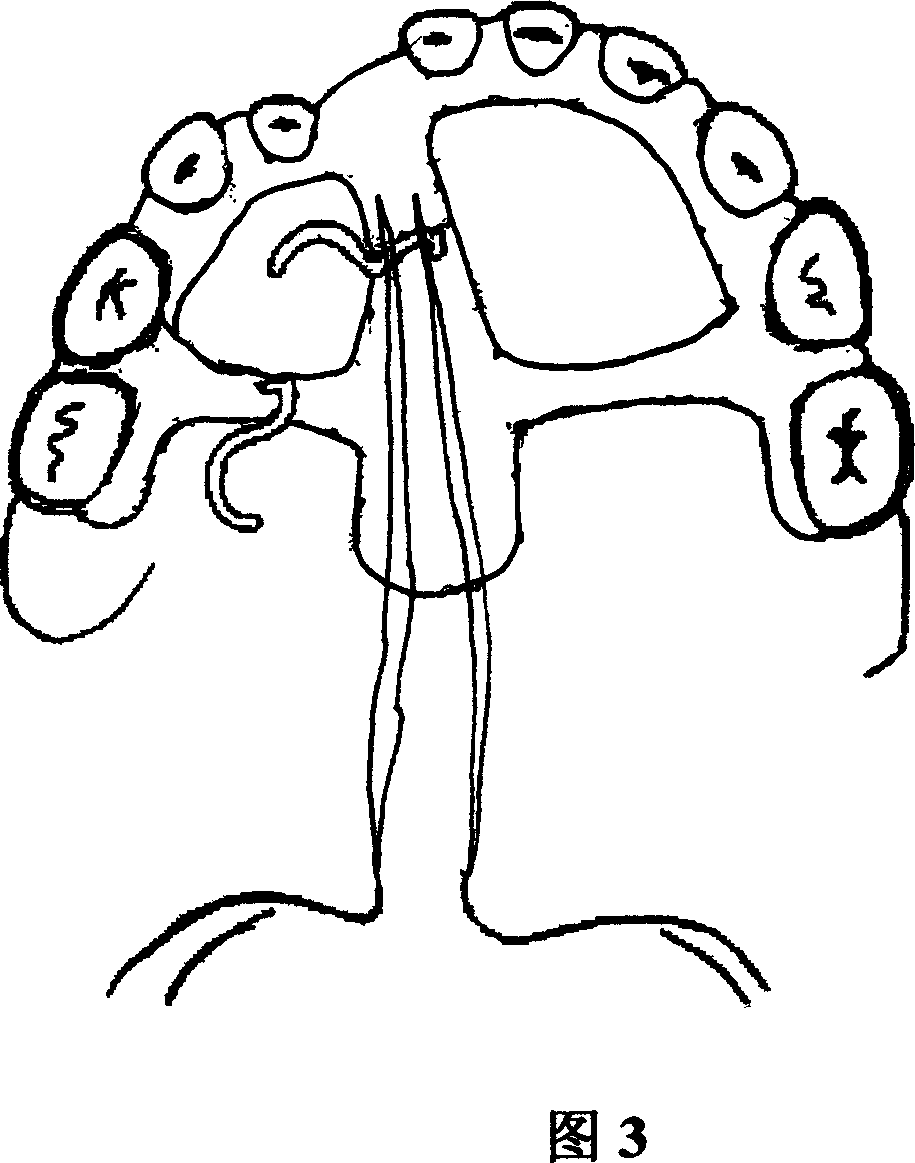 Traction device used in oral cavity for treating cleft palate made of nickel-titanium memory alloy