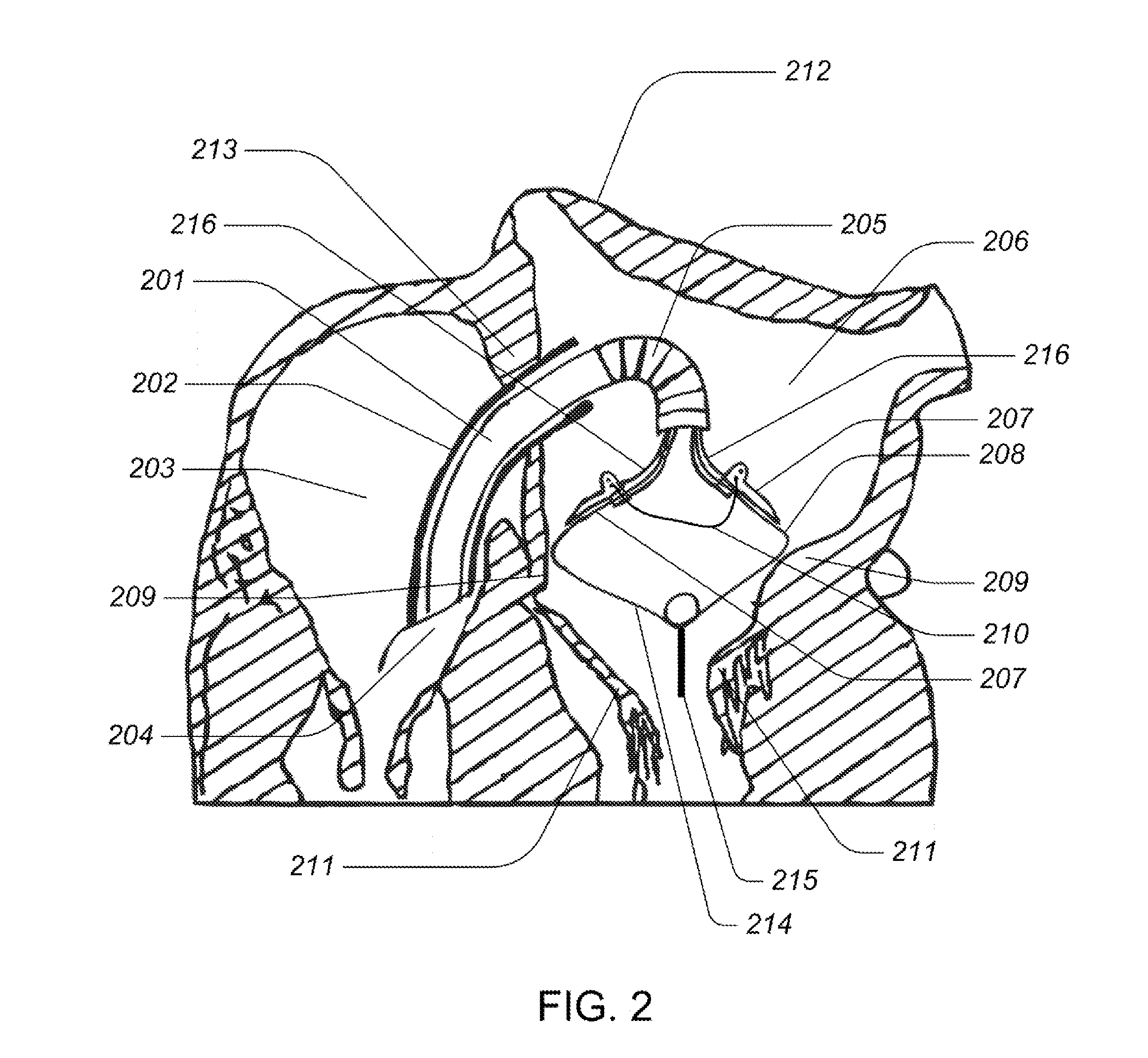 Medical kit for constricting tissue or a bodily orifice, for example, a mitral valve