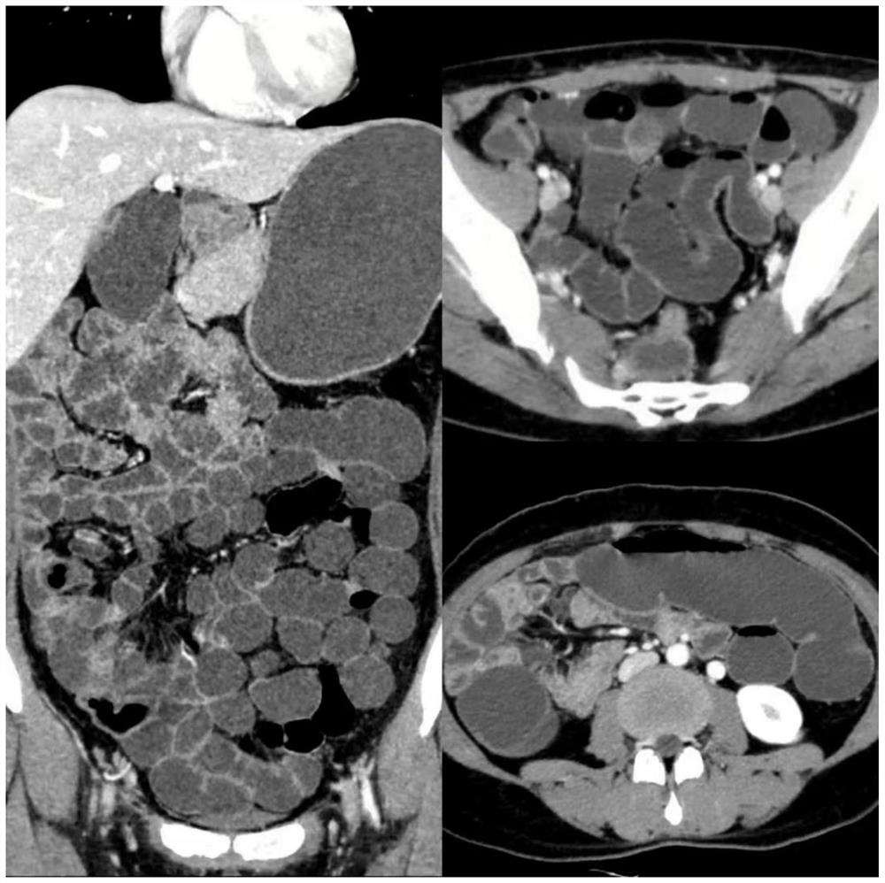 Traditional Chinese medicine composition for abdominal enhancement as well as preparation method and application of traditional Chinese medicine composition