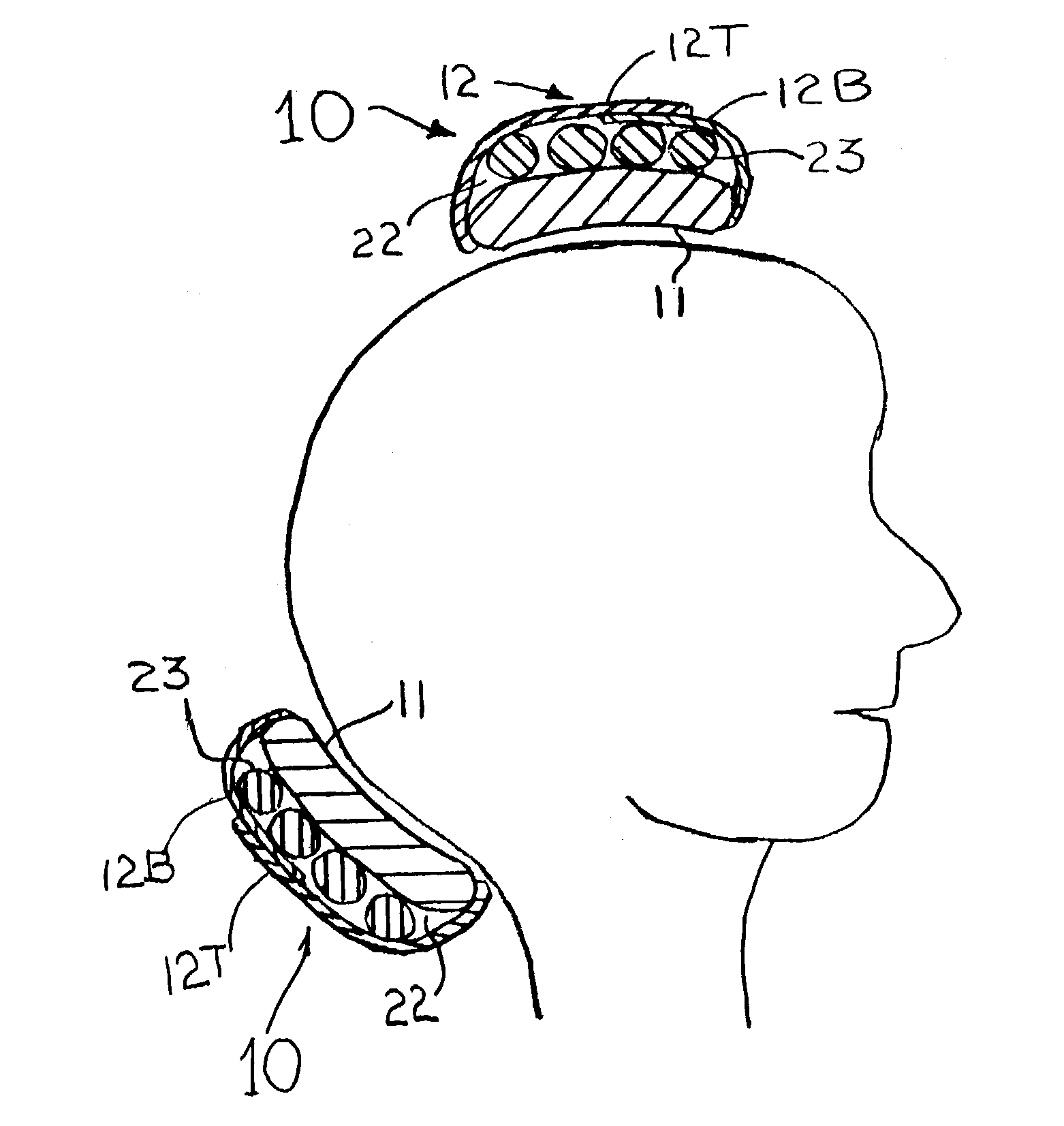 Means and methods for treating headaches