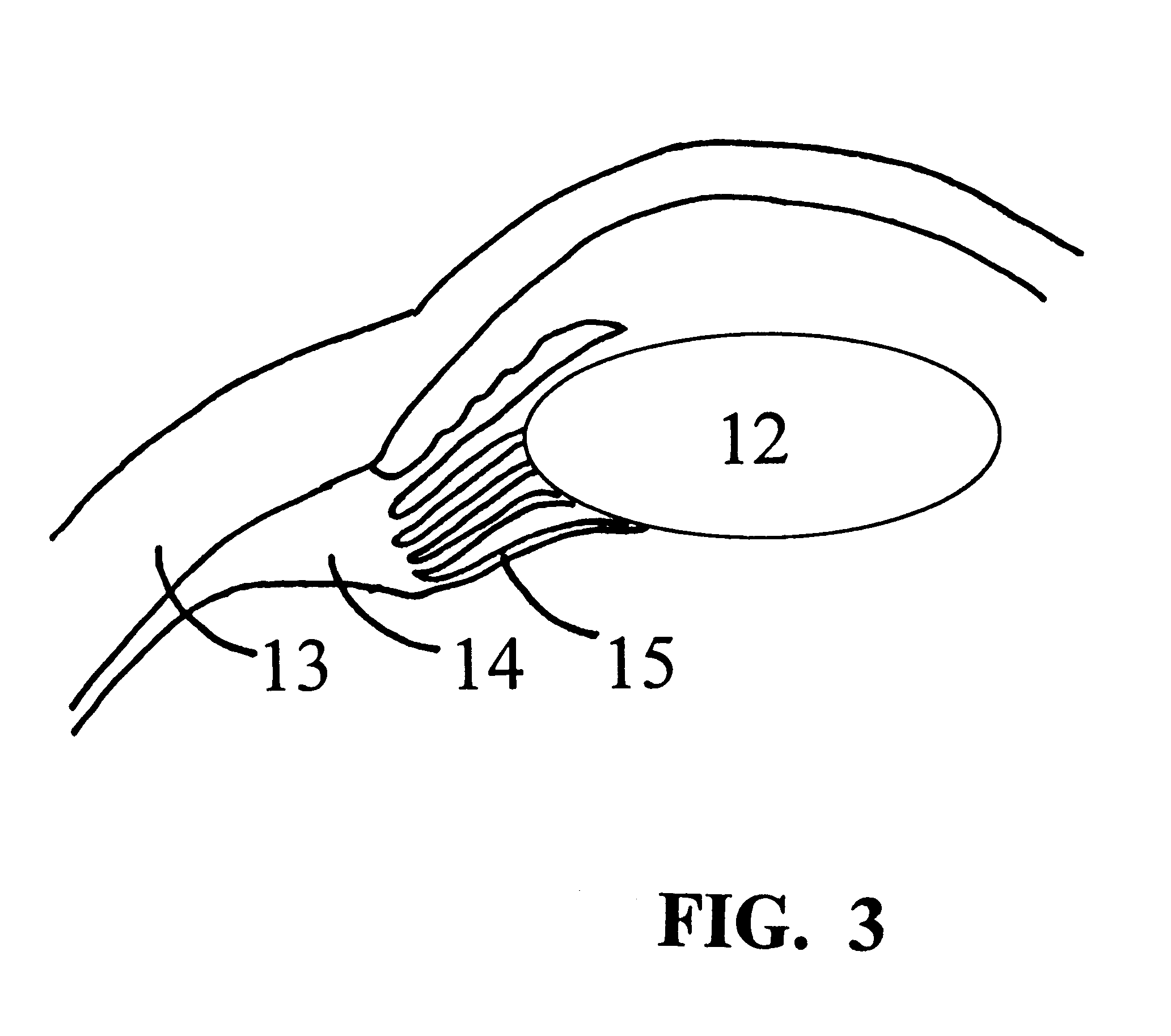 Treatment of presbyopia and other eye disorders using a scanning laser system