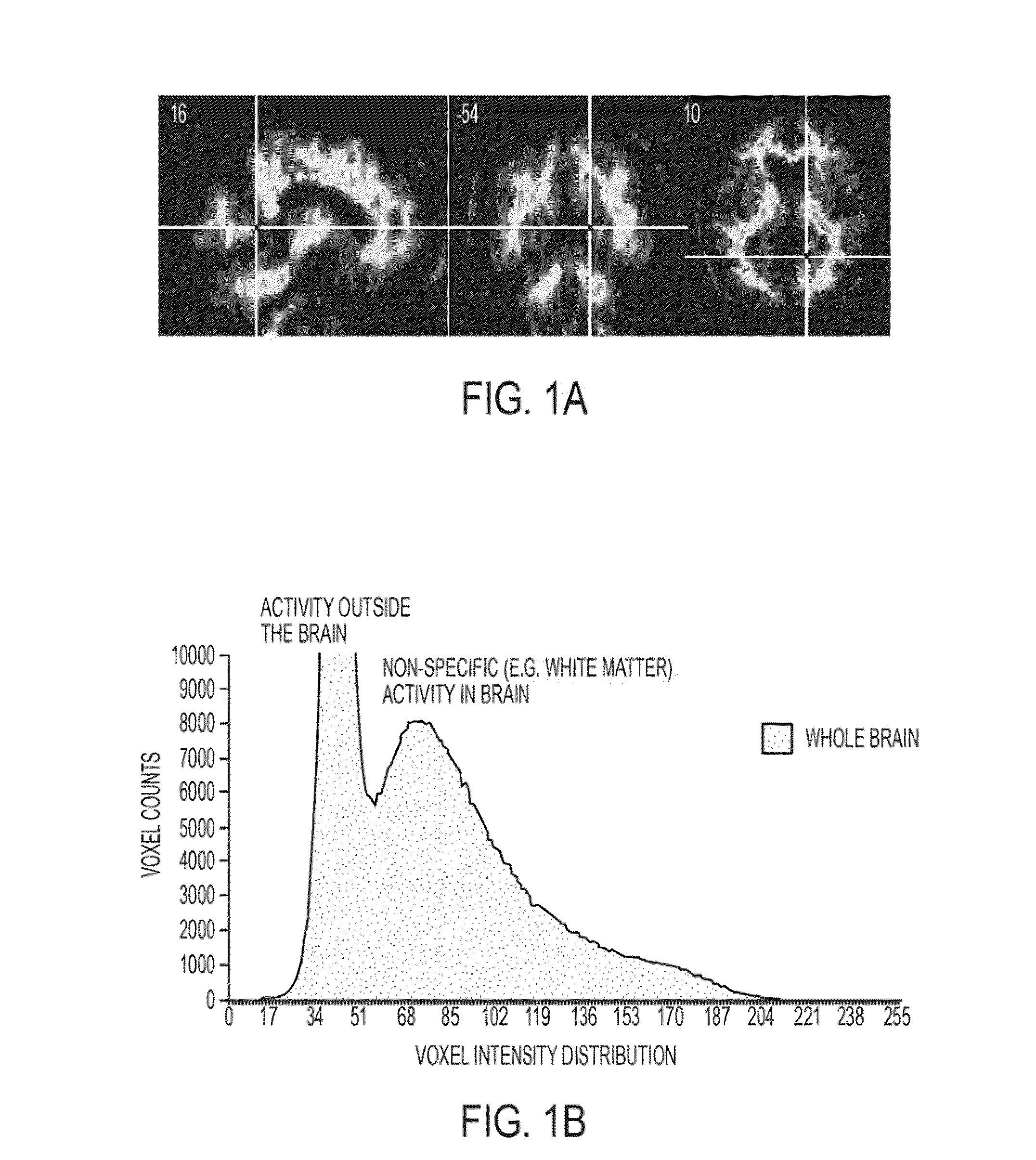 Histogram-based analysis method for the detection and diagnosis of neurodegenerative diseases