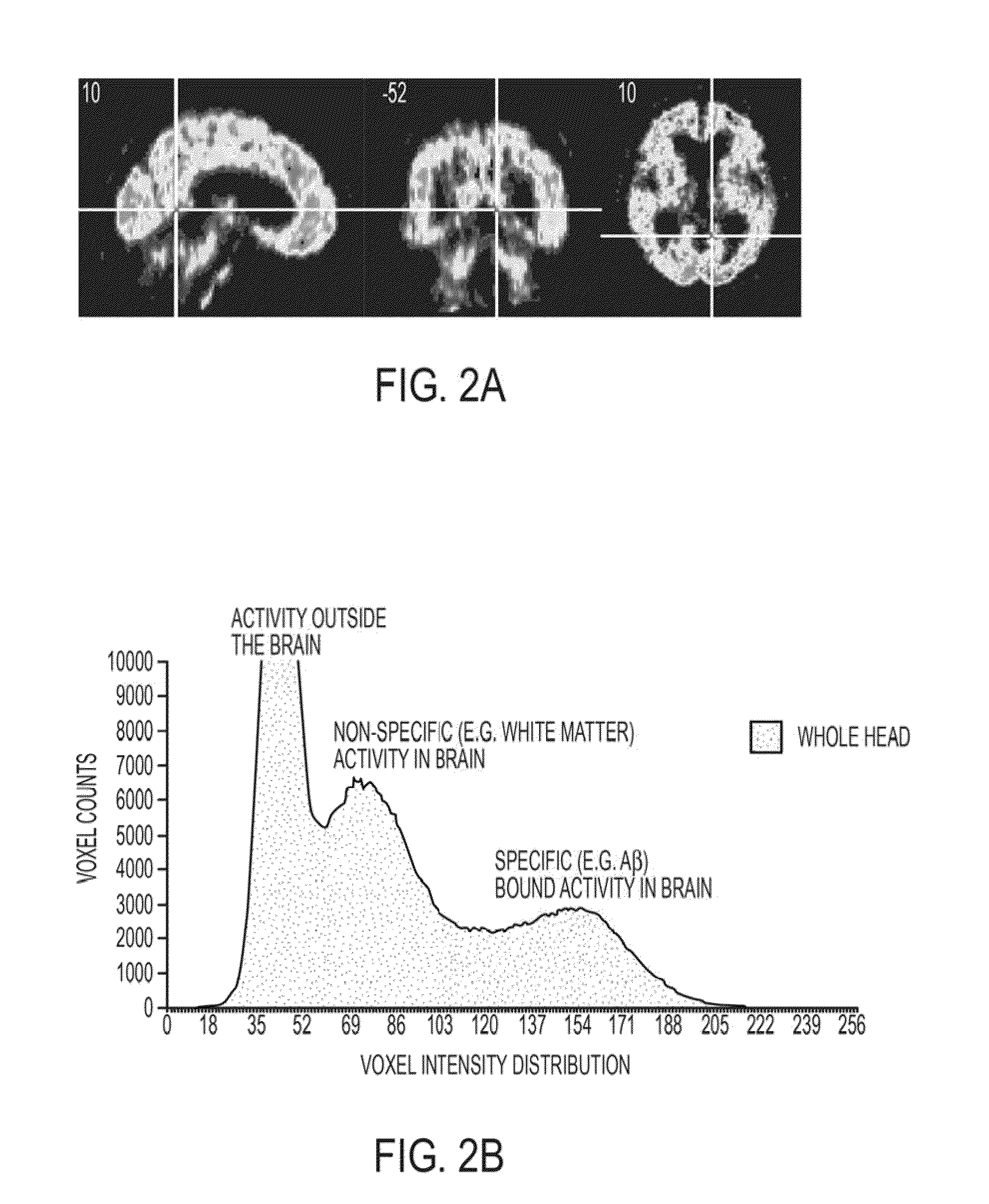 Histogram-based analysis method for the detection and diagnosis of neurodegenerative diseases