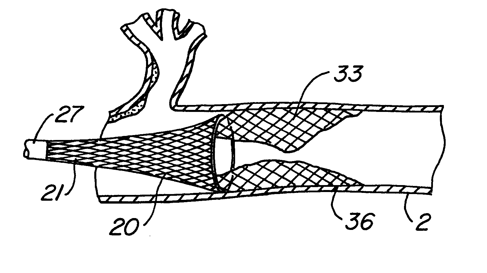 Tissue separation medical device and method