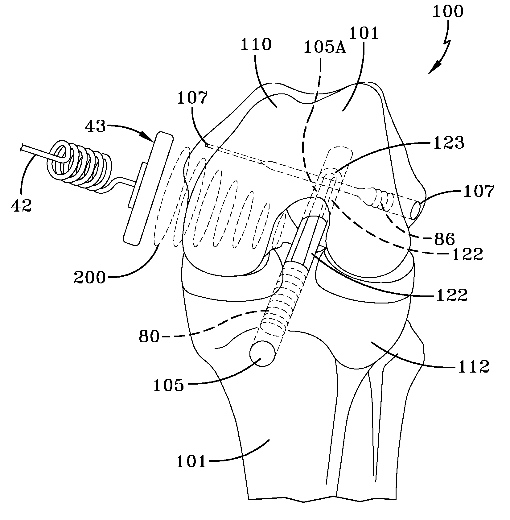 Method of Attaching Soft Tissue to Bone