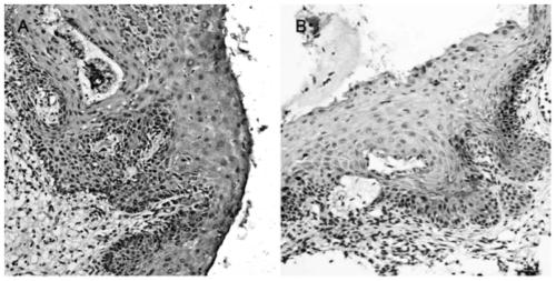 Marker (MYC) for predicting cervical lesions occurrence of HPV positive patients