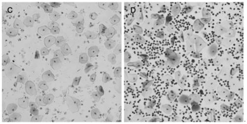 Marker (MYC) for predicting cervical lesions occurrence of HPV positive patients