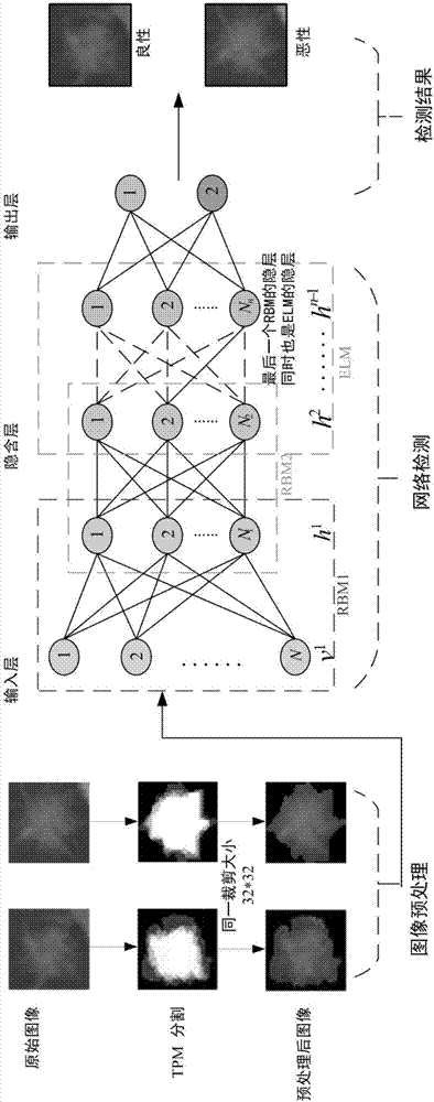 Improved deep Boltzmann machine-based pulmonary nodule feature extraction and benign and malignant classification method