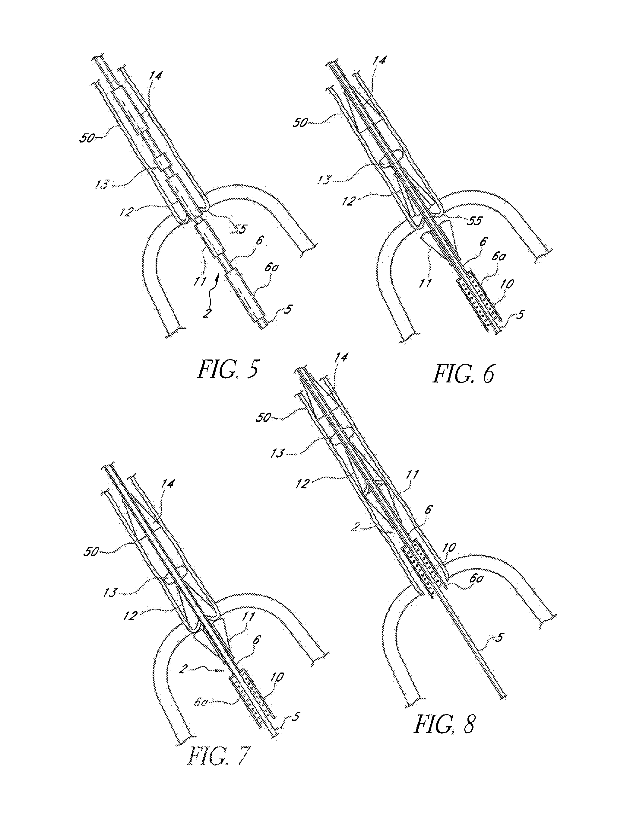 Methods for delivering a self-expanding valve