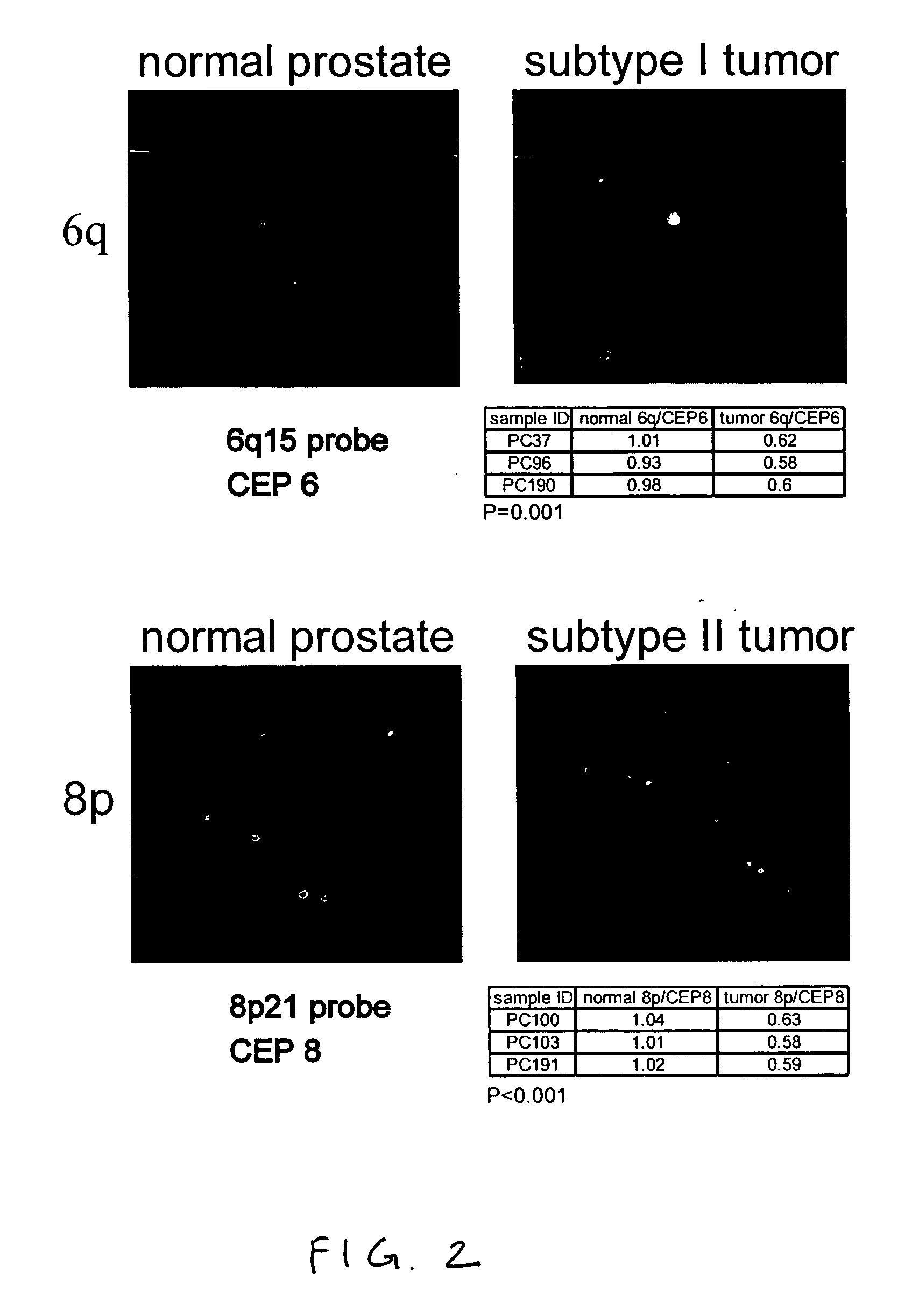 Markers of DNA copy number alteration for improved prognostication in prostate cancer