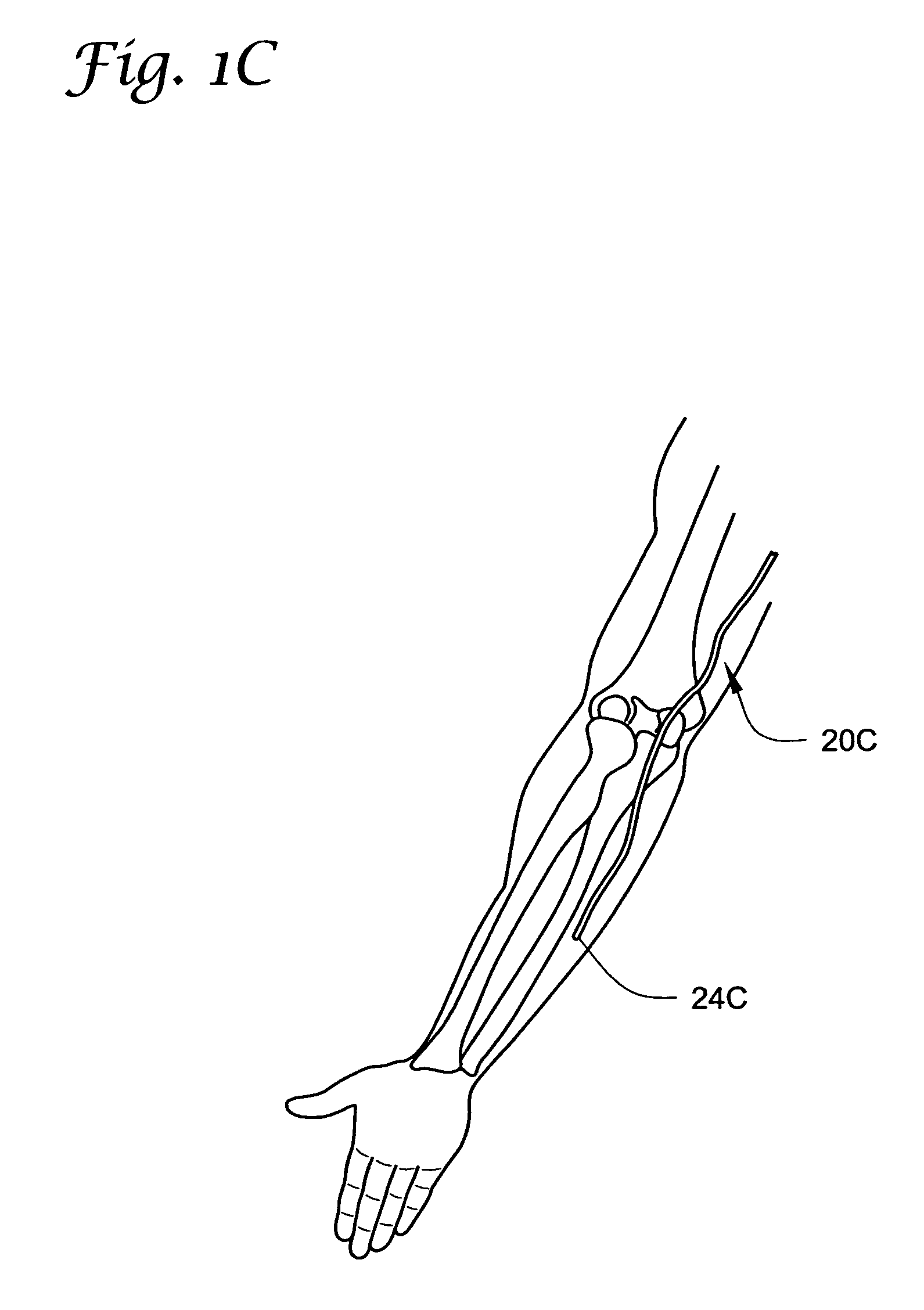 Reduction of inflammatory mass with spinal catheters